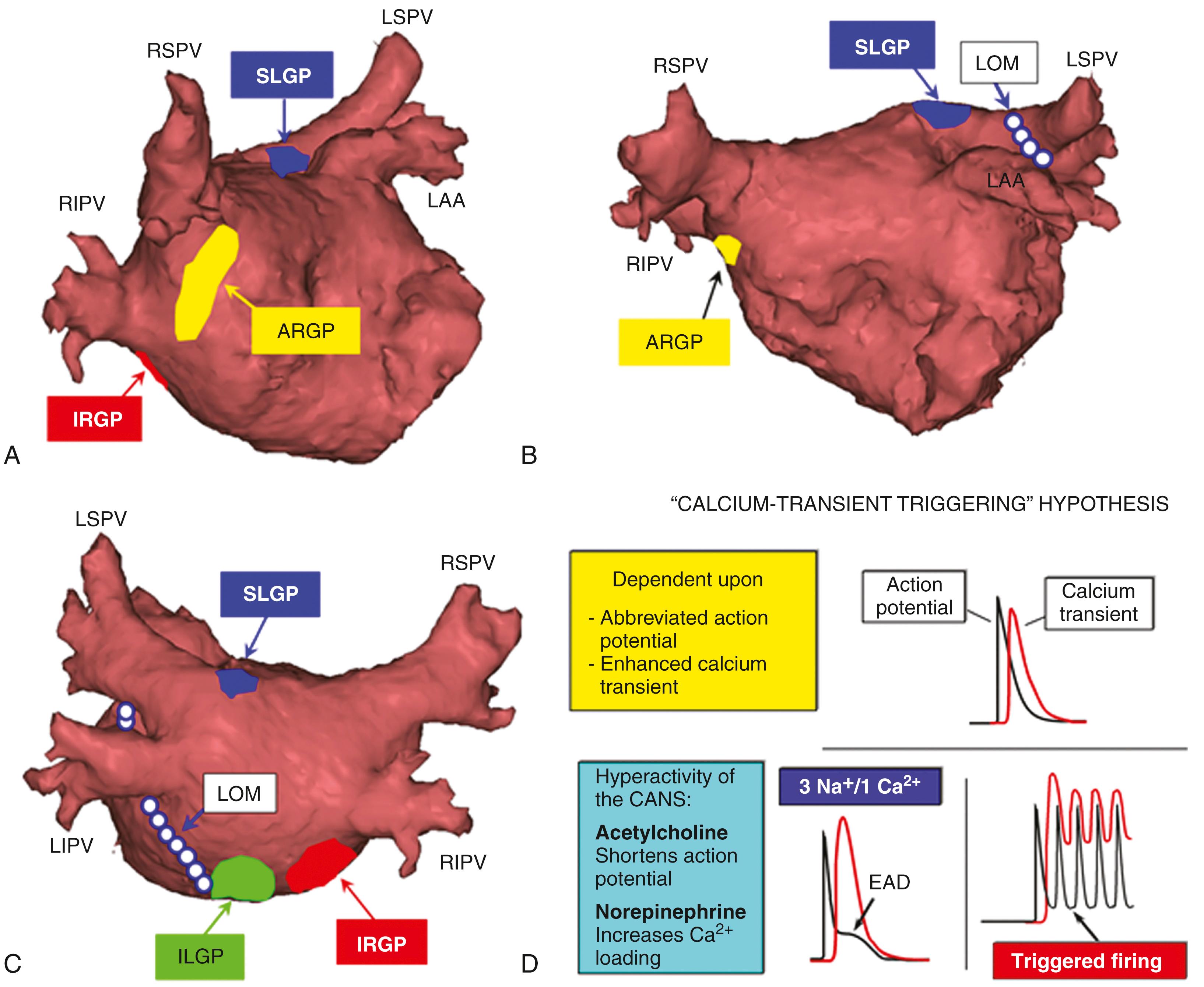 Fig. 42.1, Location of the major atrial ganglionated plexi and ligament of Marshall (LOM).