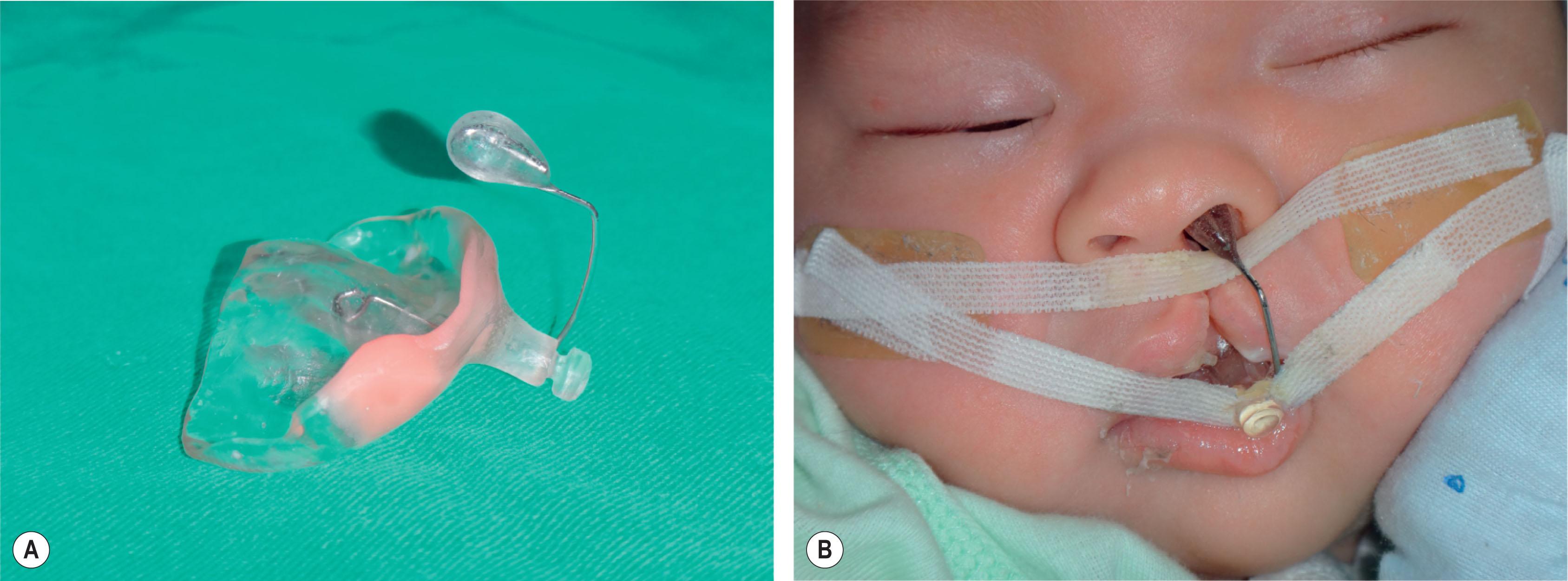 Figure 19.2.1, (A) Modified Grayson’s molding device. (B) The device held in proper position by elastics and tapes. Lip taping helps to approximate the alveolus.