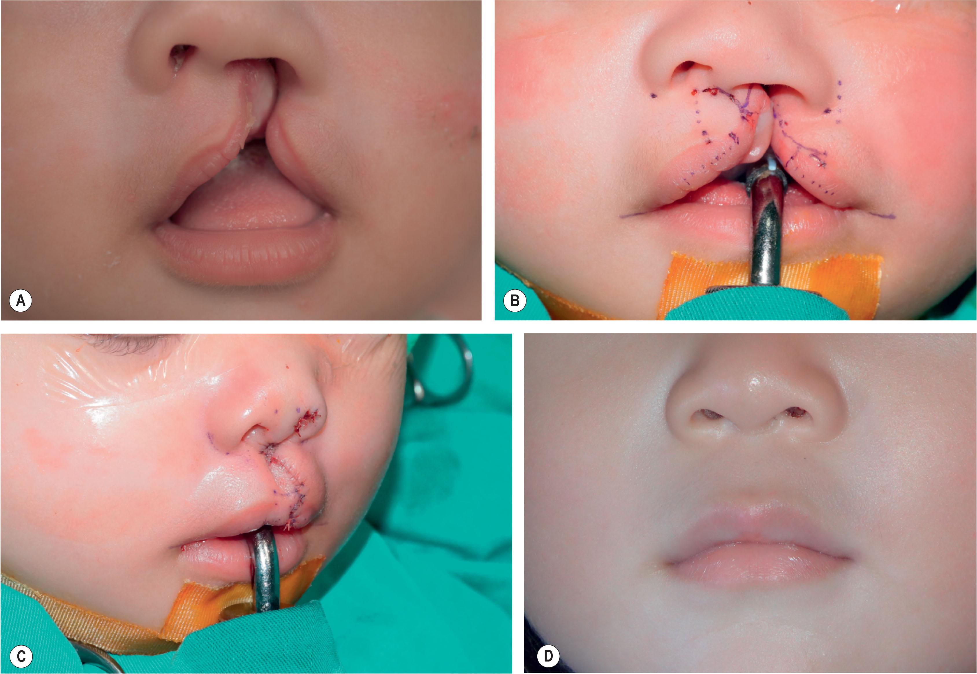 Figure 19.2.11, (A) The width of the white skin roll is widest at point CPHIR and becomes narrower toward the point CPHIL. (B) A WSR flap is designed above the point CPHIL′ according to the width of WSR above CPHIR. (C) The WSR flap helps to level the Cupid’s bow, correct the WSR deficiency at the point CPHIL while reconstructing the upper lip contour line. (D ) The upper lip contour line. There is a horizontal groove at the upper margin of the WSR.