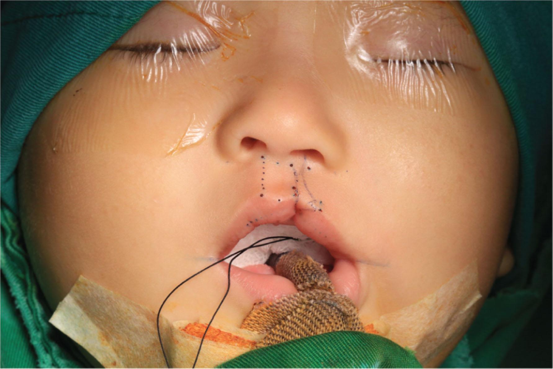 Figure 19.2.14, Marking for the simple rotation incision if the height discrepancy is less than 2 mm. A WSR flap is still designed for restoring of the lip contour line.