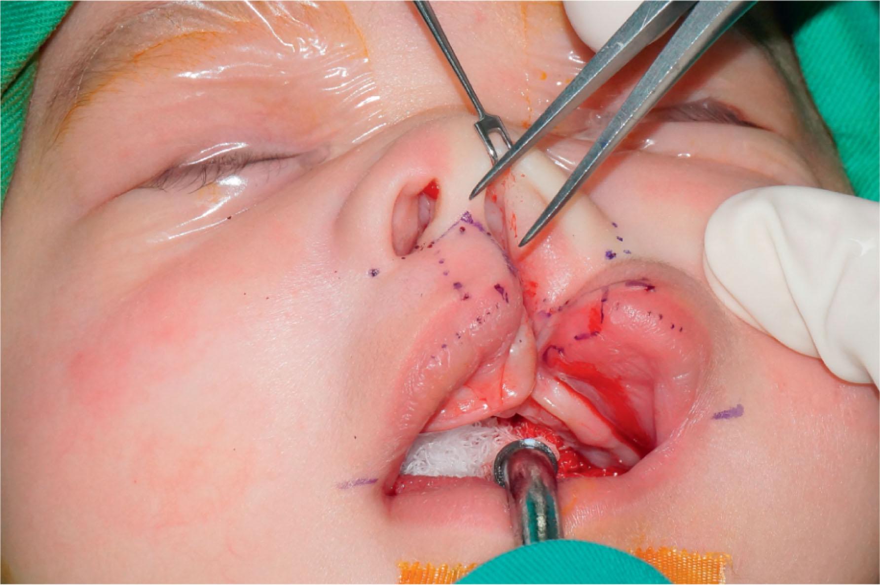 Figure 19.2.15, The incision of the Mohler’s technique. The lip height on the cleft margin is similar to the lip height on the non-cleft side. The angle of the back-cut is around 90°.