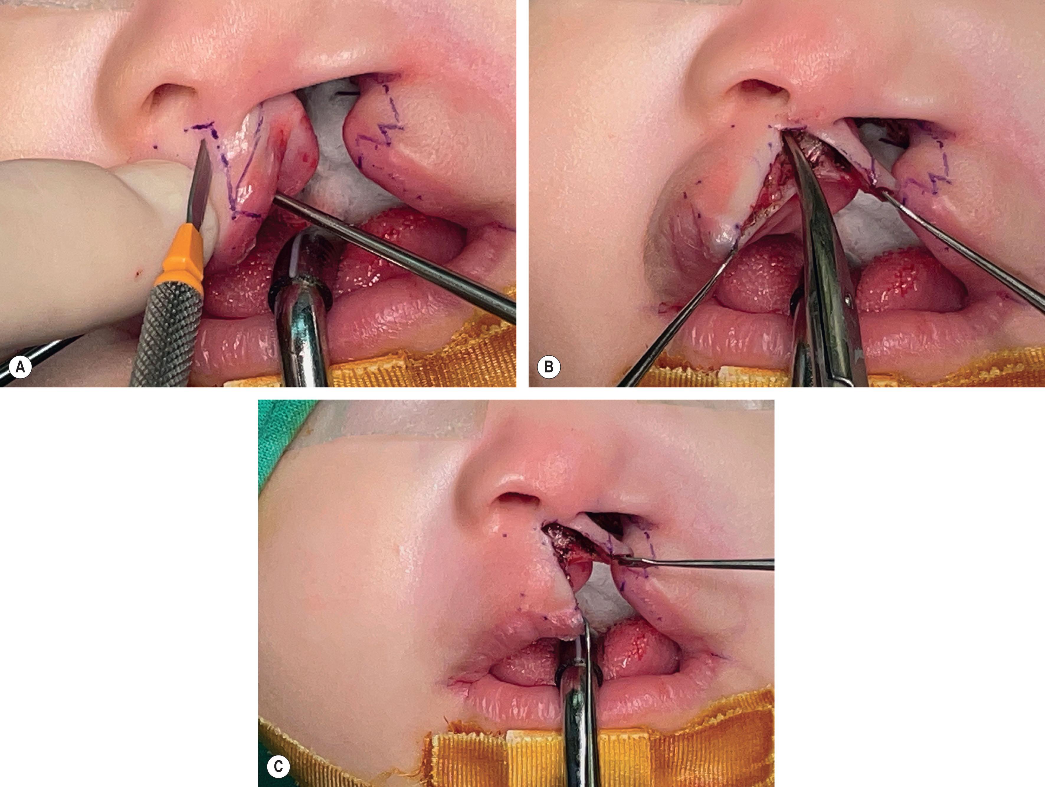 Figure 19.2.16, (A) The lip is stabilized with hooks and fingers while incised with a No. 67 blade to ensure an accurate cut. (B) Adequate muscle dissection should reach the nasal floor of the non-cleft side to release the abnormal muscle insertions to the columellar base. (C) Downward traction on the free border of the lip will determine if the rotation is adequate, that is both points CPHIR and CPHIL are at the same level.