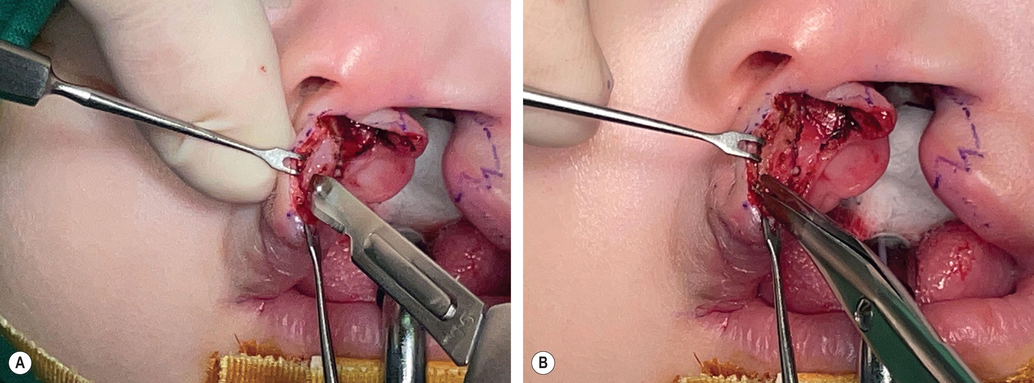 Figure 19.2.17, (A) Muscle layer is dissected along the skin edge initially with a blade. (B) The muscle dissection is then continued with a pair of tenotomy scissors. The abnormal muscle insertion beneath the columellar base and nasal floor is released followed by muscle attachment to the skin in the subdermal plane to the midline of philtrum. The dissection plane is deeper initially leaving a cuff of muscle on the incisional edge and gradually to the subdermal level for better philtral ridge morphology.