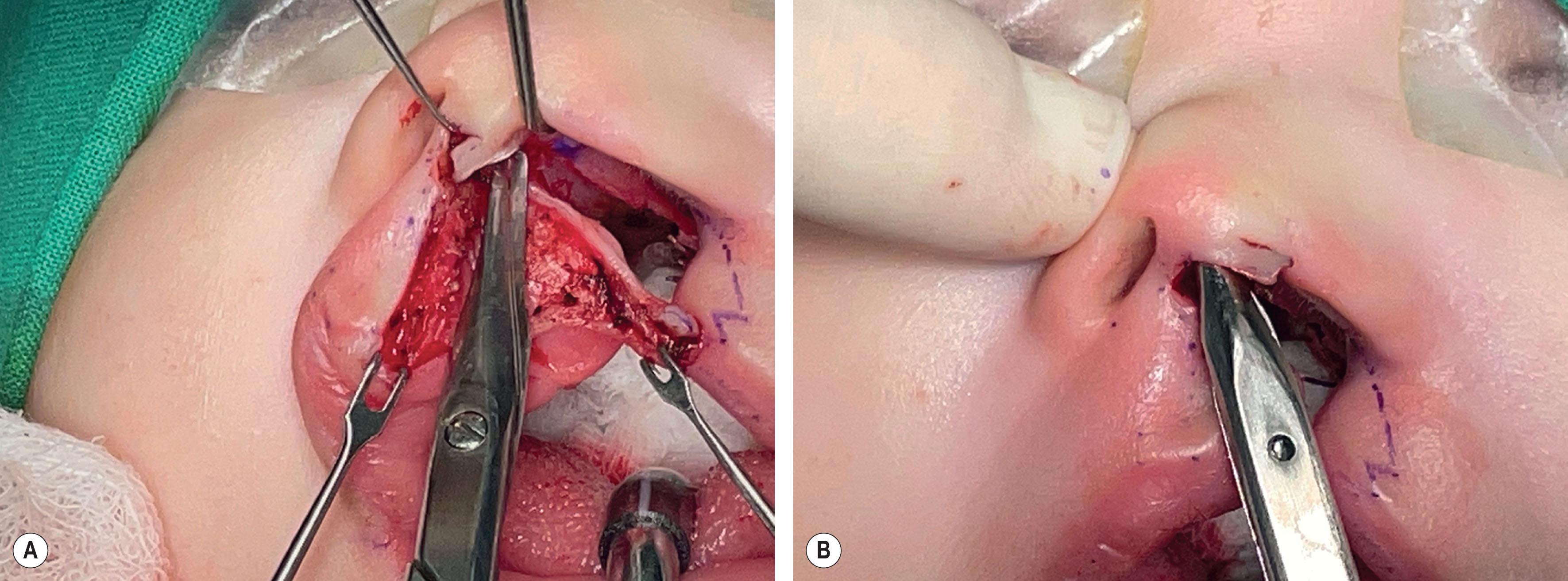 Figure 19.2.18, (A) The C-flap is extended from the point CPHIL along the skin and mucosa junction to the deepest point of the skin overlying the premaxilla. At the premaxilla, the incision turns superiorly along the junction of columellar skin and septal mucosa. Use a tenotomy scissors to separate the C-flap from the underlying premaxilla and septum. (B) Separating the inter-crural space will allow upward repositioning of the displaced foot plate of the medial crura on the cleft side.