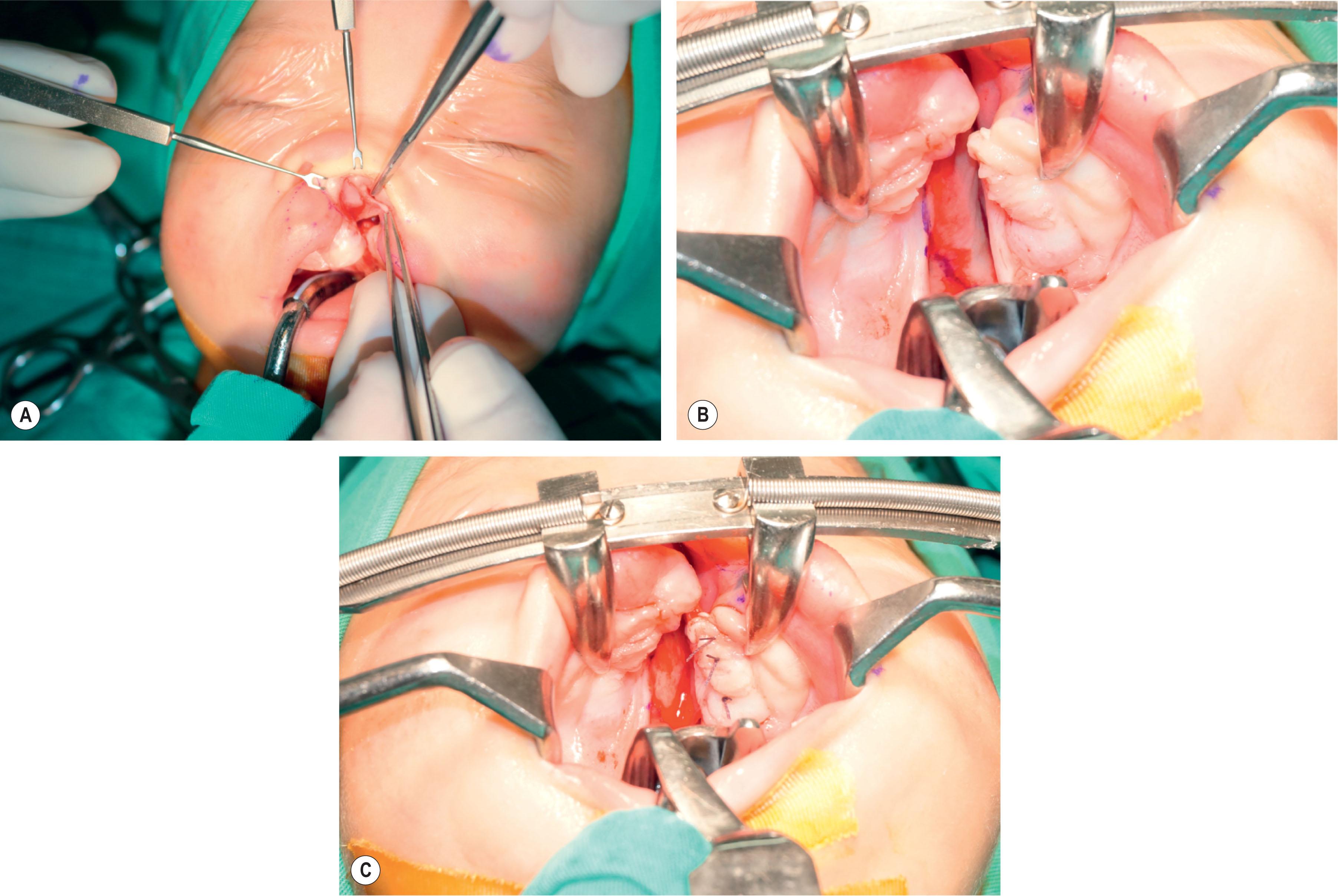 Figure 19.2.19, (A) The septal flap is extended backward connecting to the vomer flap if the anterior palate is repaired together with lip repair. The dislocated septal cartilage can be repositioned through this approach. (B) Intraoral view shows the incision line of the superiorly based vomer flap. Its anterior part is connecting with the septal flap. (C) The vomer flap is imbricated under the mucoperiosteum of the lesser segment. In front of the alveolus, the septal flap will be sutured to the L-flap.