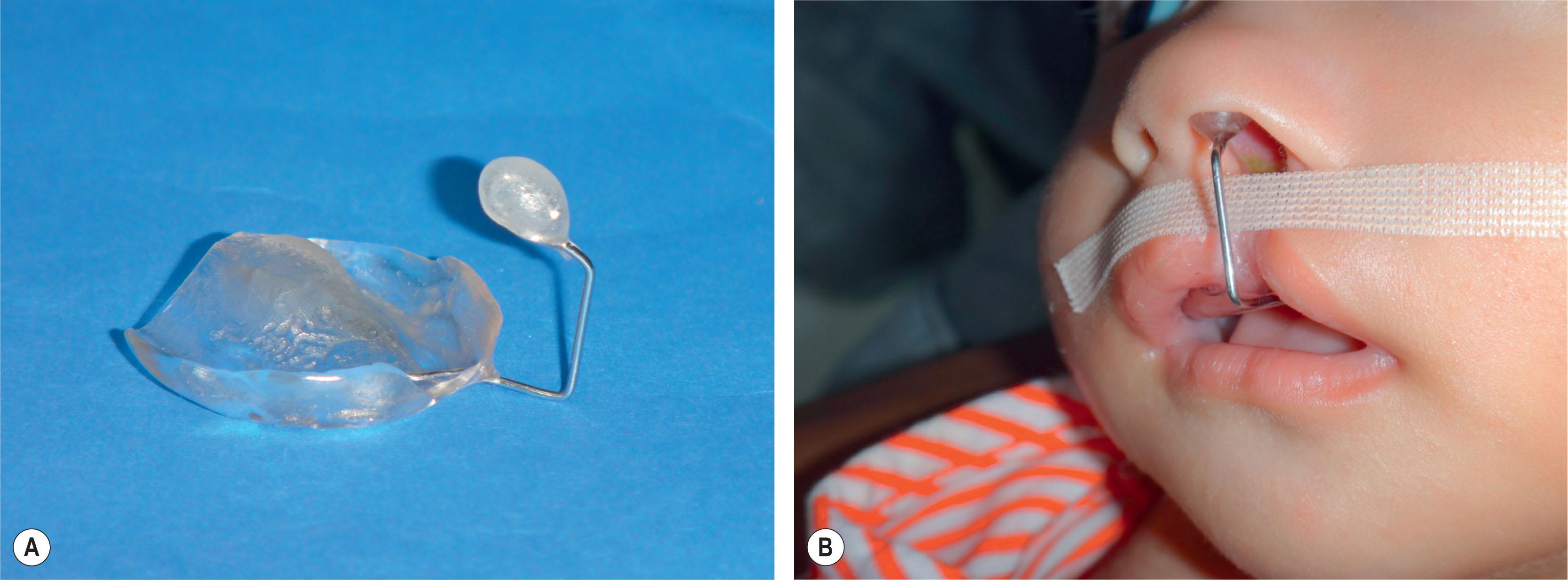 Figure 19.2.2, (A) Modified Figueroa’s molding device. (B) The device held in proper position by dental adhesives. Lip taping is also used.