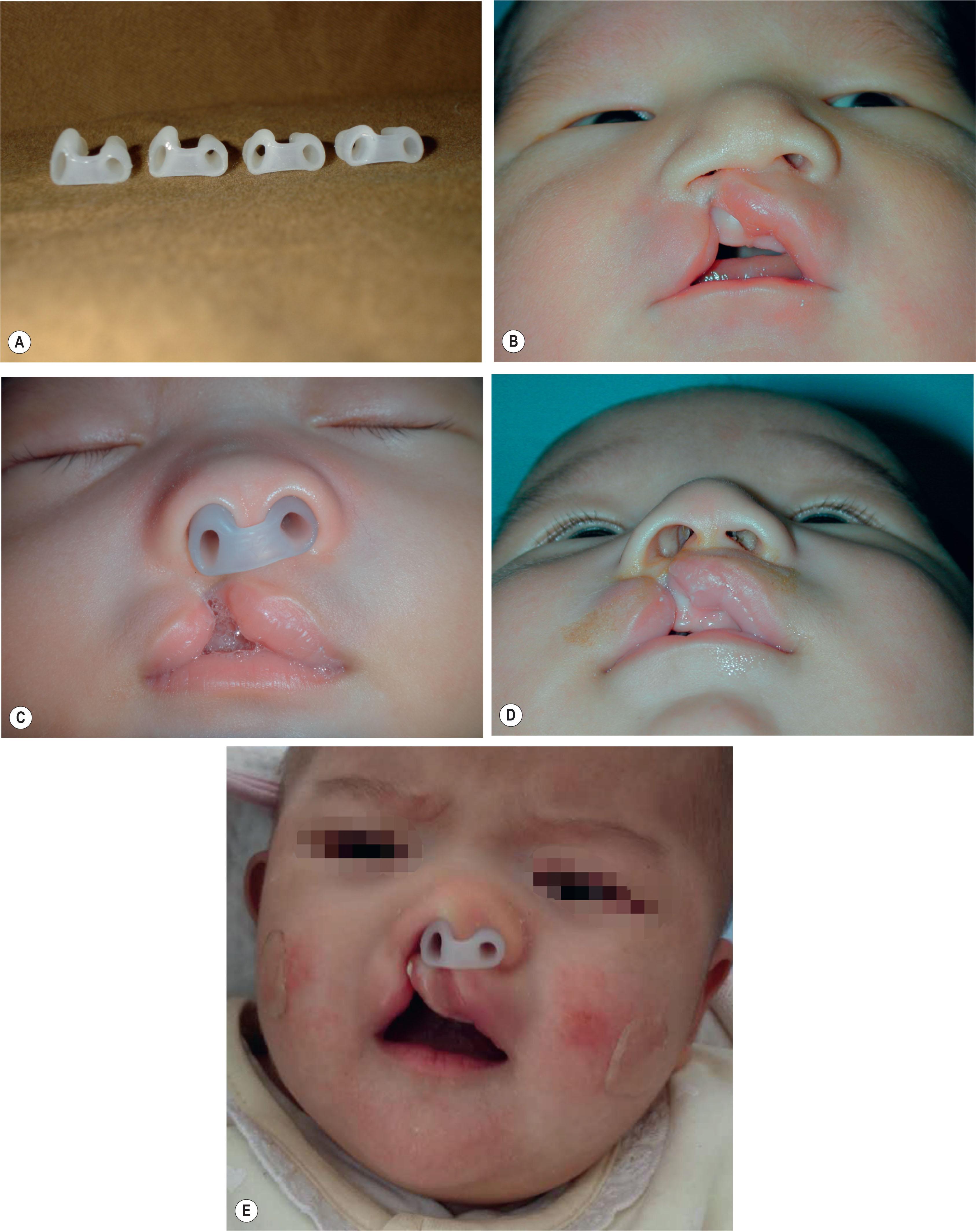 Figure 19.2.3, (A) A set of nasal conformers with different height (with 1 mm increment) on the cleft side. The conformer is narrower on the cleft side as the cleft-side nostril will be widened by time after operation. (B) A 10-day-old baby with right incomplete cleft lip. Nasal shape before the nasal molding. (C) Nasal molding with silicone nasal conformer. The right No. 2 conformer is 2 mm higher on the cleft side to achieve symmetry. (D) Same baby at the age of 3 months before lip repair. The alar shape is fairly symmetrical after nasal molding. (E) A baby with right complete cleft of the primary palate. A No. 3 silicone nasal conformer was used for nasal molding. The conformer can elevate the depressed ala on the cleft side pushing the protruding premaxilla backward.