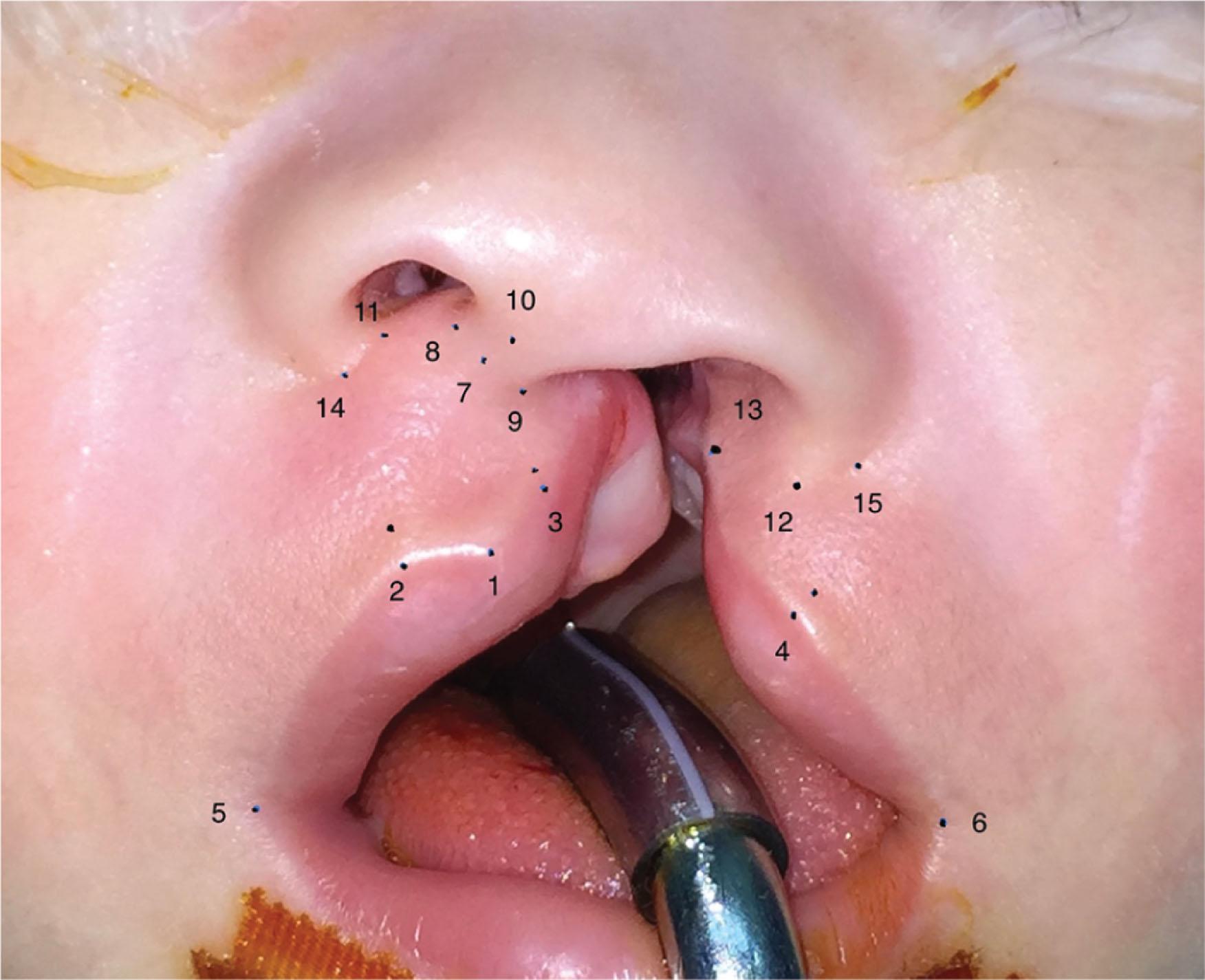 Figure 19.2.4, The landmarks used for cleft lip and nose repair.