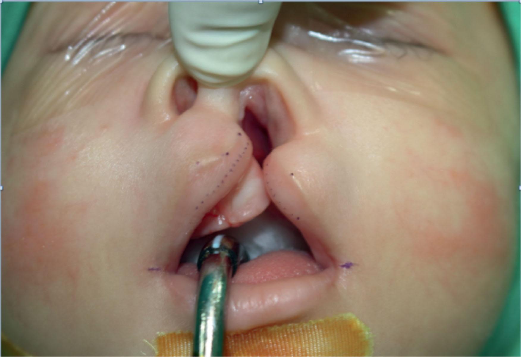 Figure 19.2.5, Pushing the nasal tip upward with a finger helps to define the point LS.