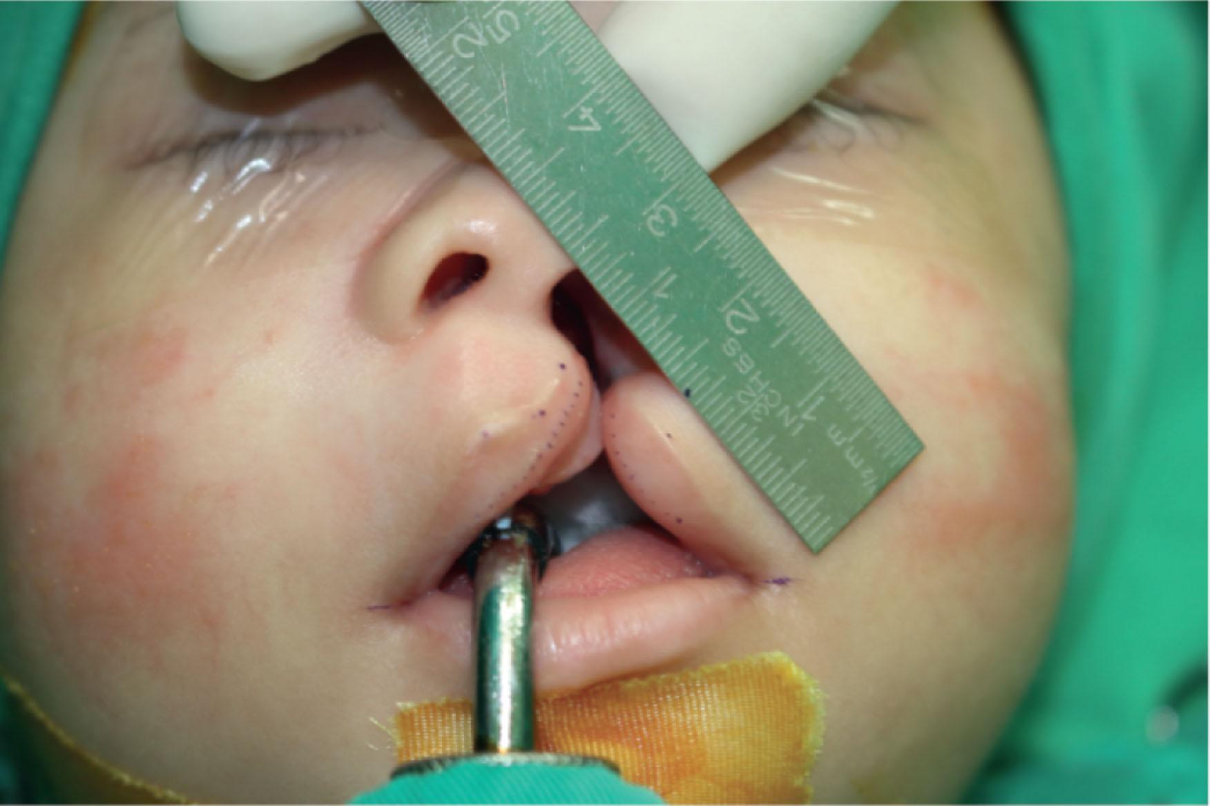 Figure 19.2.7, The point CPHIL′ is where the vermilion first become its widest. Although the horizontal lip length is 2 mm shorter on the cleft side, this point is still chosen at its anatomical position.