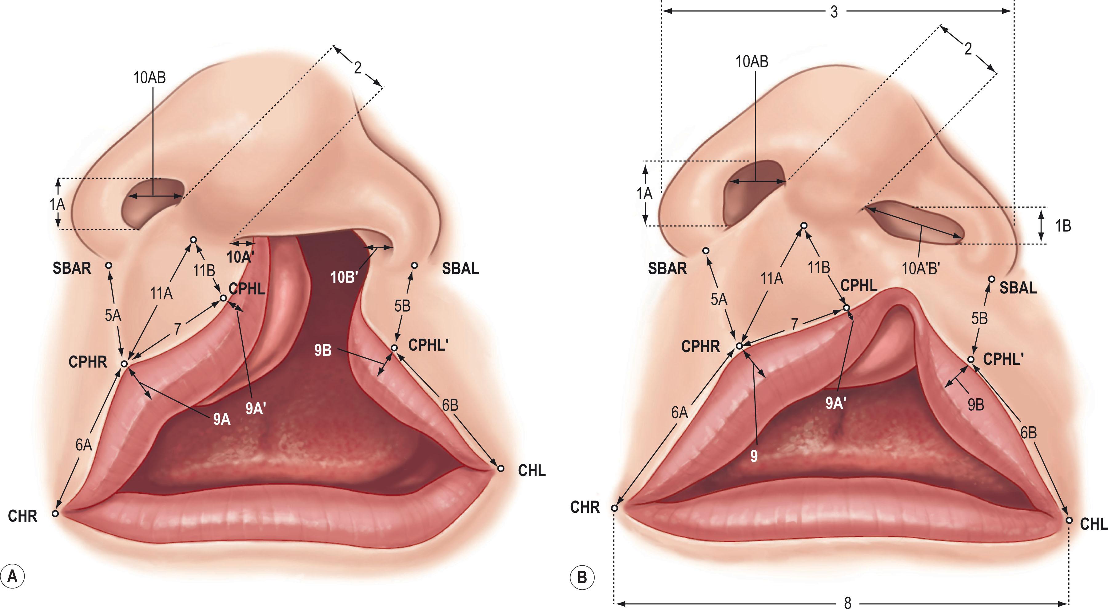 Figure 19.2.8, (A) Unilateral complete cleft with anthropometric markings for measurements. (B) Similar markings for unilateral incomplete cleft lip. For abbreviations see text.