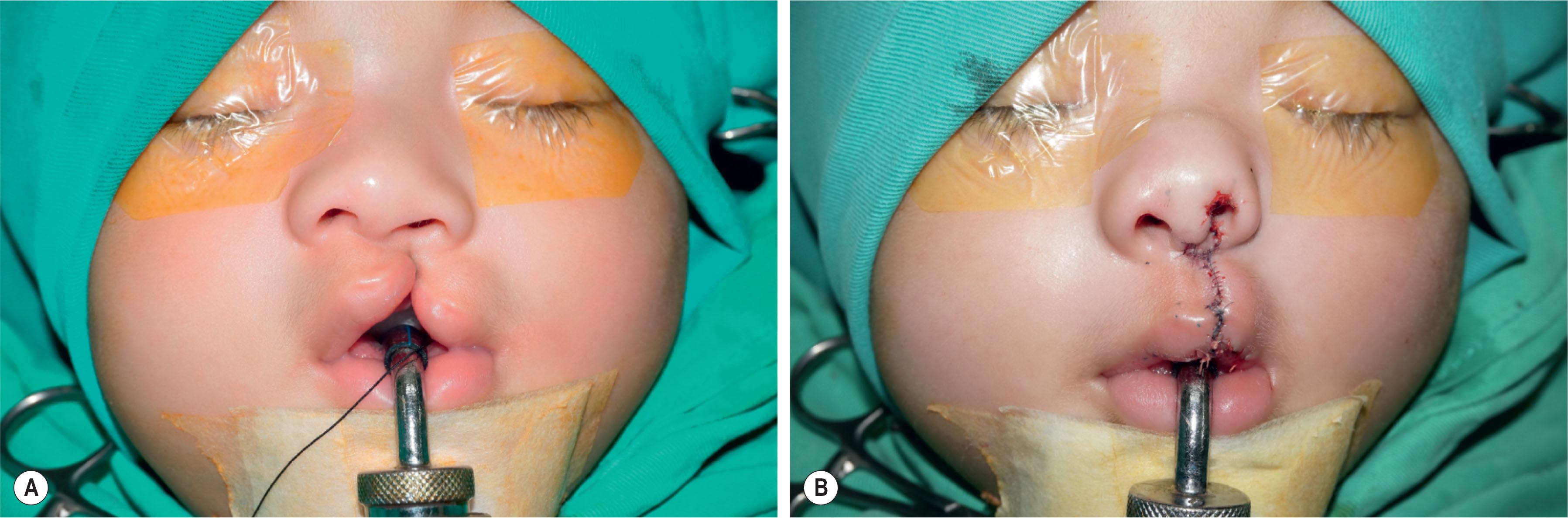 Figure 19.2.10, (A) Although the vertical lip height seems longer on the cleft side, the height measurement between the two sides shows a similar result. The long lip is a false impression due to the downward displaced alar base. (B) Moving the whole lateral lip/alar base upward can achieve a symmetrical lip without shortening of the skin and muscle on the nasal floor. The excess in free border needs to be trimmed.