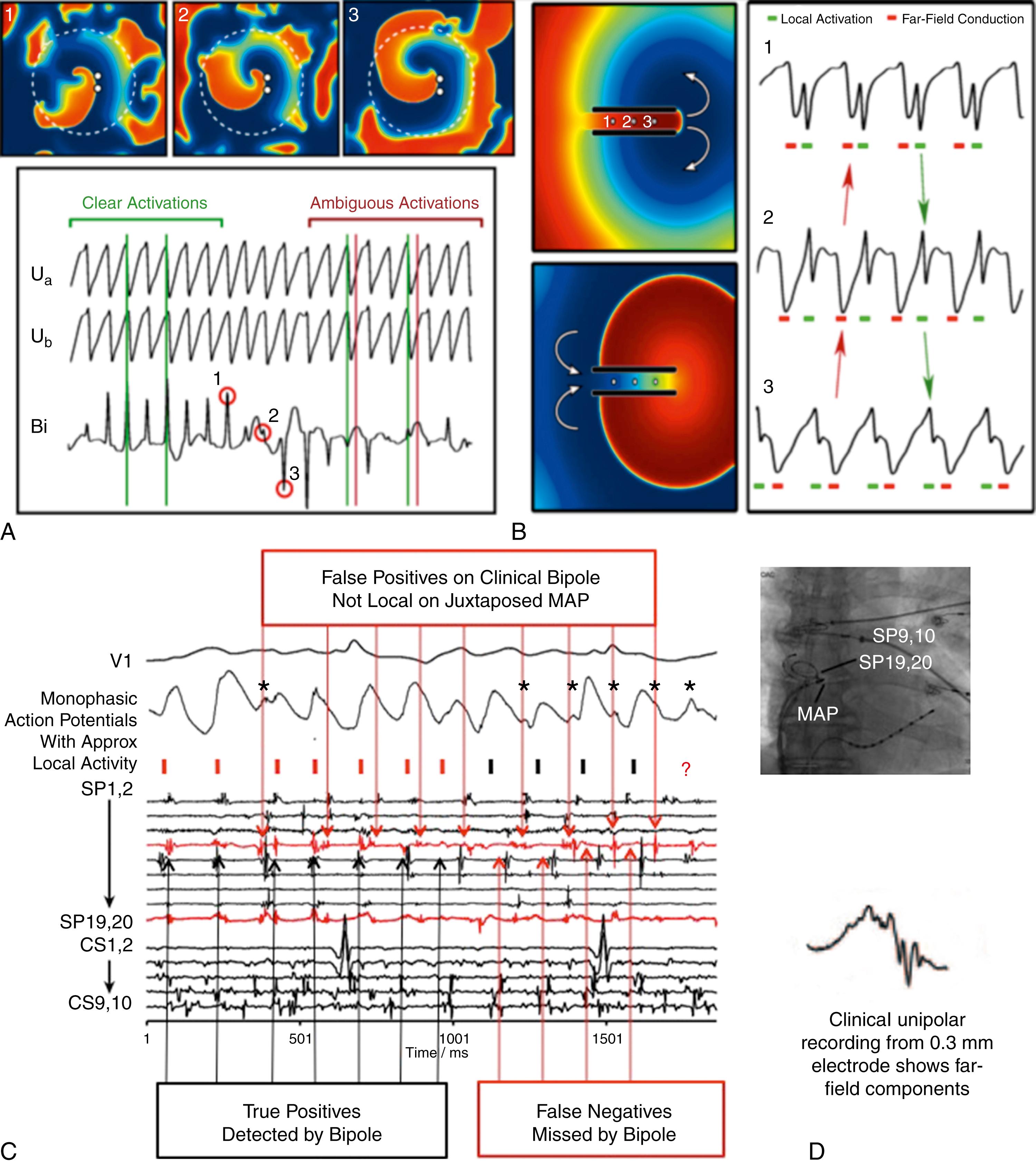 Fig. 43.4, Difficulties in electrogram interpretation in atrial fibrillation (AF).