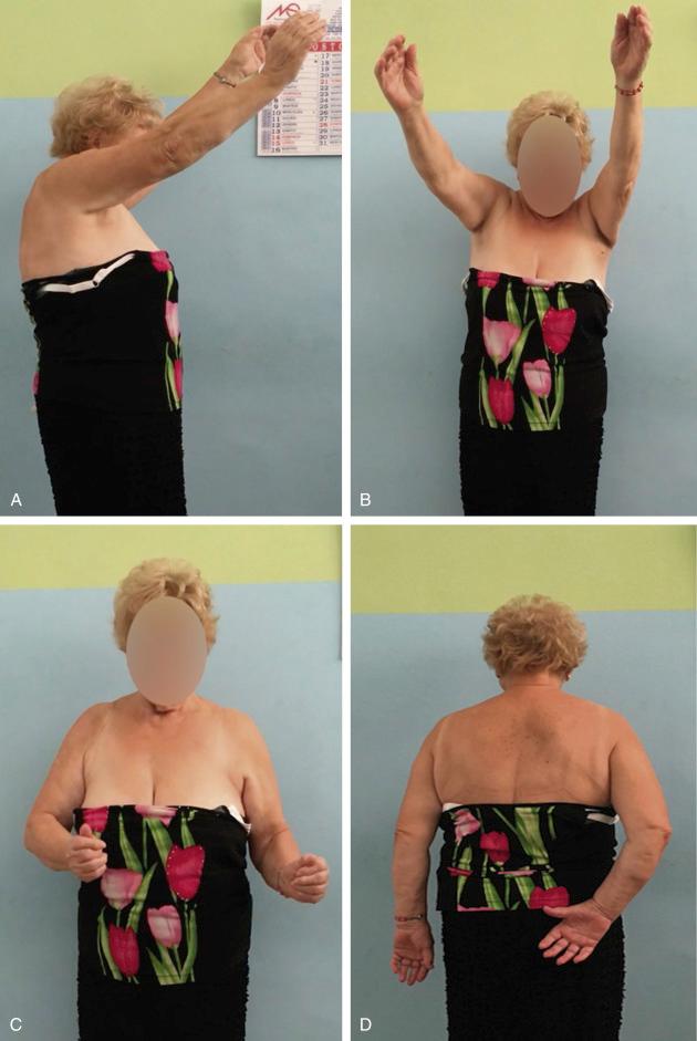 FIG. 36.1, (A–D) Decrease in range of motion in a 75-year-old female patient with right rotator cuff arthropathy.