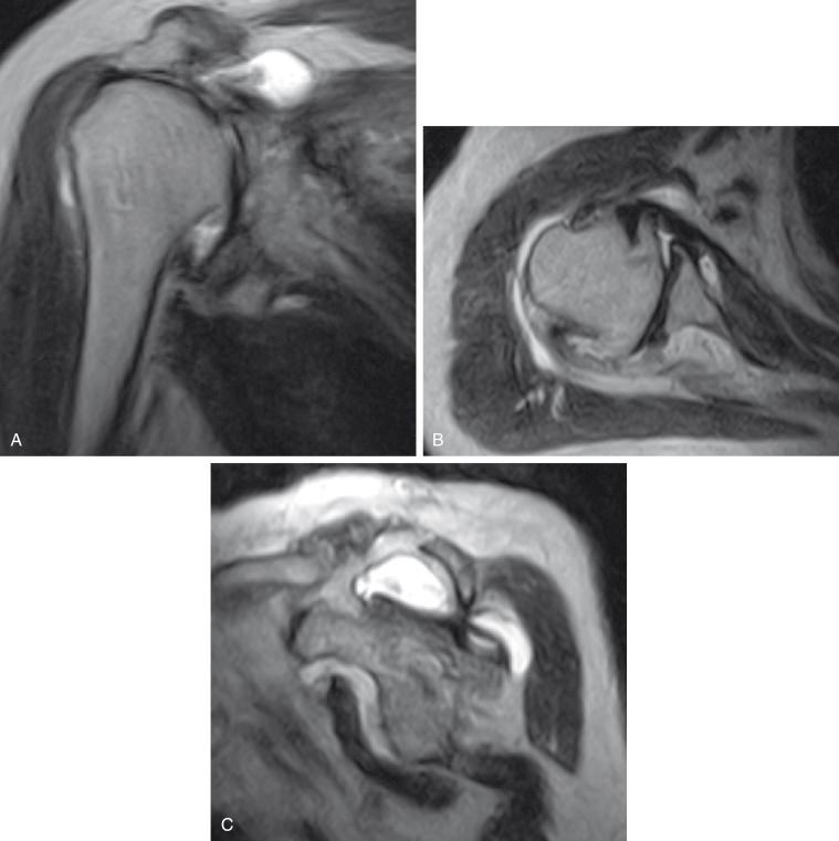 FIG. 36.2, Magnetic resonance imaging of a right shoulder of a 77-year-old male patient with Hamada grade 4B cuff tear arthropathy. (A) Coronal T2 fat-suppressed. (B) Axial proton density fat-suppressed. (C) Sagittal T2 fat-suppressed.