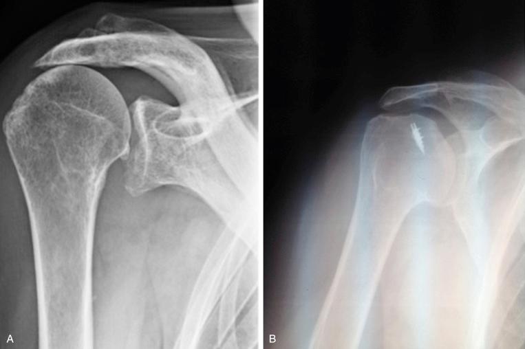 FIG. 36.3, True anteroposterior x-rays of a right shoulder. (A) Hamada grade 3 cuff tear arthropathy. (B) Hamada grade 5 cuff tear arthropathy: bony destruction and humeral head collapse after a cuff repair failure.