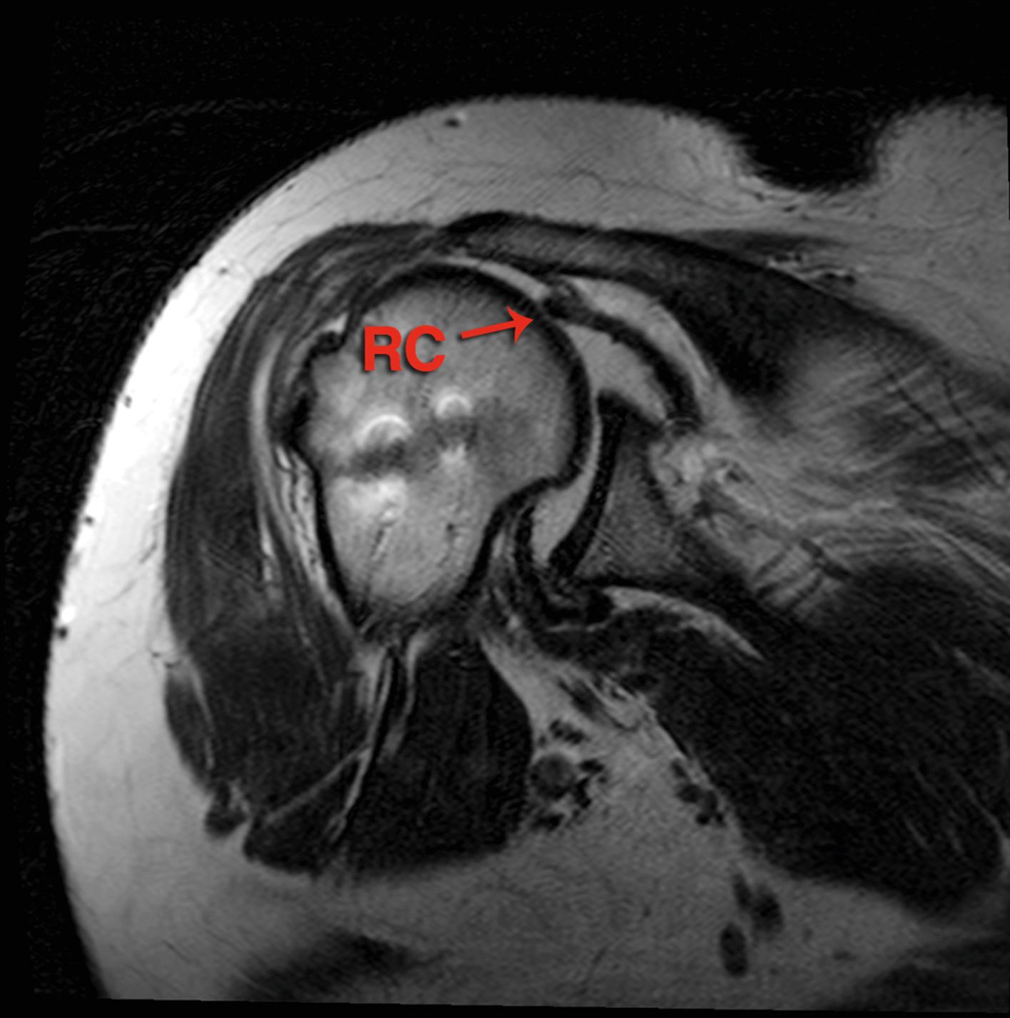 FIG. 7.1, MRI coronal view of the right shoulder with irreparable cuff tear planned to undergo superior capsule reconstruction. RC , rotators cuff remnant.