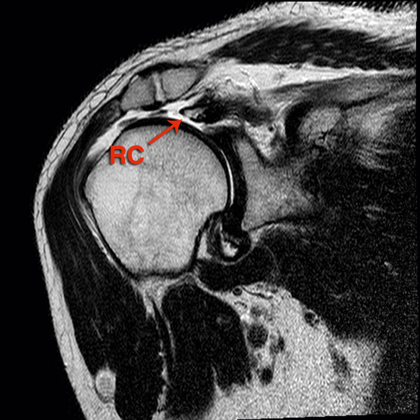 FIG. 7.2, MRI coronal view of the right shoulder with the massive cuff tear planned to undergo patch augmented repair. RC , rotators cuff.