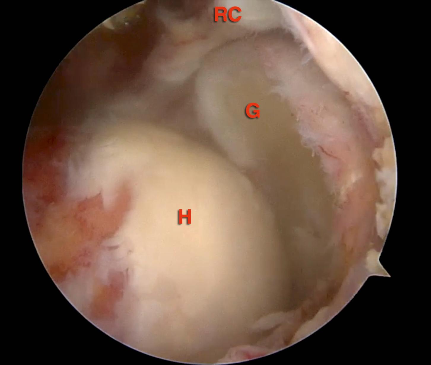 FIG. 7.3, Intraoperative arthroscopic view of the irreparable cuff tear in the right shoulder. Scope is positioned in an anterosuperolateral portal. G , glenoid; H , humeral head; RC , rotators cuff remnant.