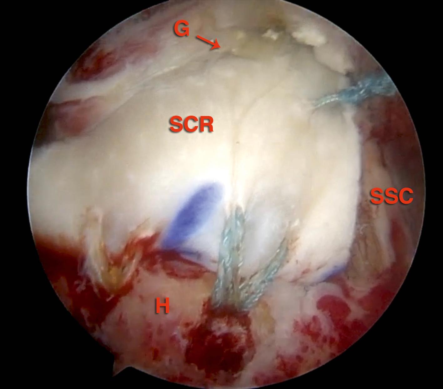 FIG. 7.4, Arthroscopic view of the completed superior capsule reconstruction performed in the right shoulder. Scope is positioned in the anterosuperolateral portal. G , glenoid; H , humeral head; SCR , superior capsule reconstruction graft; SSC , subscapularis tendon.