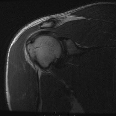 Fig. 6A.1, MR image of supraspinatus contusion.