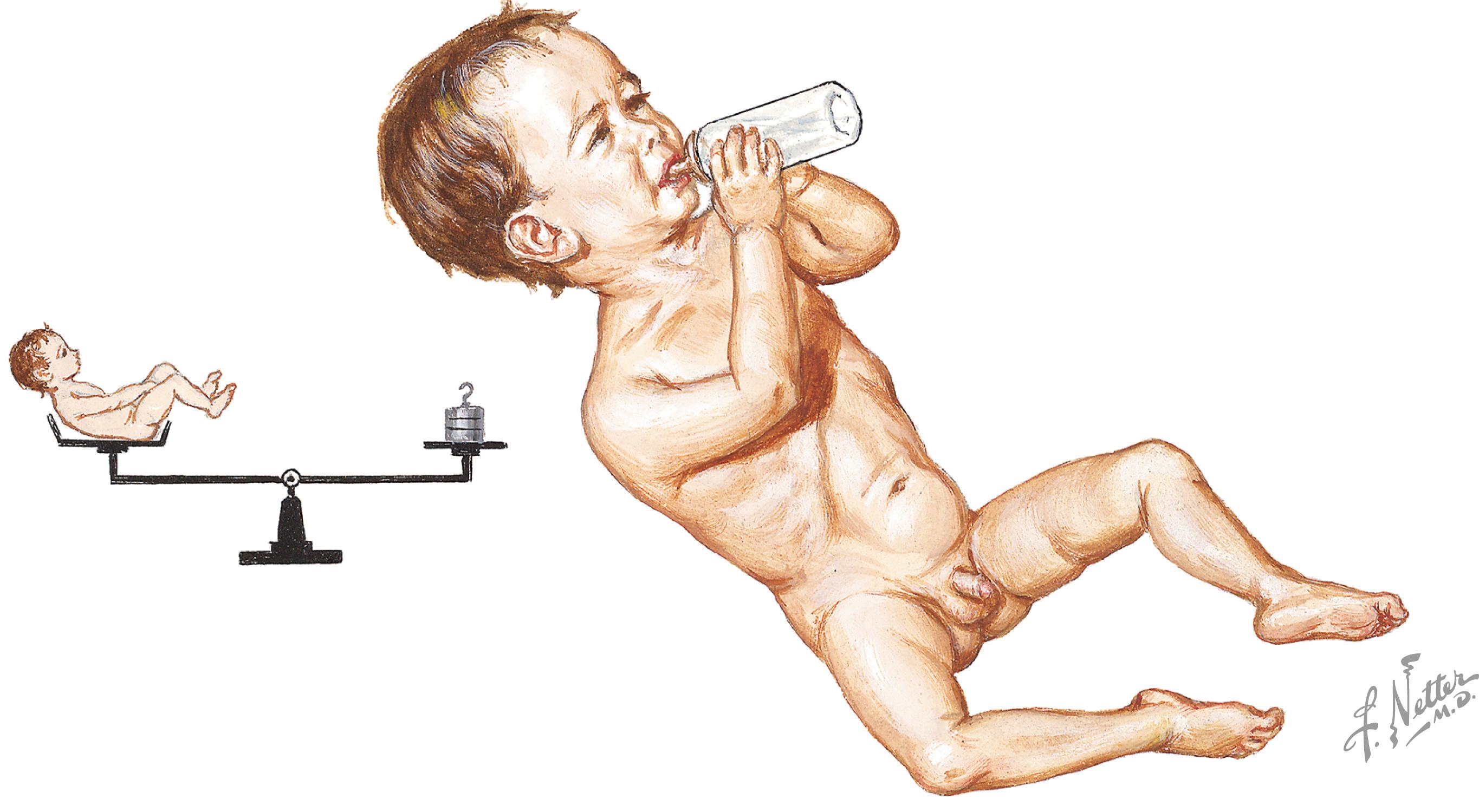 Fig. 9.1, Low birth rate and use of formula rather than breastfeeding are risk factors for rotavirus infection in infants. The bottle-fed boy shows signs of dehydration from rotavirus infection.