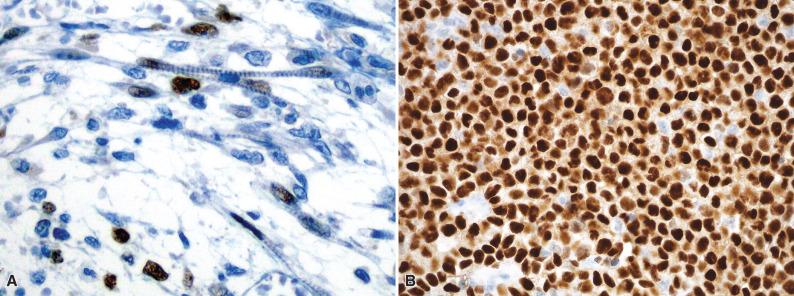 Figure 8.12, Myogenin in Rhabdomyosarcoma.