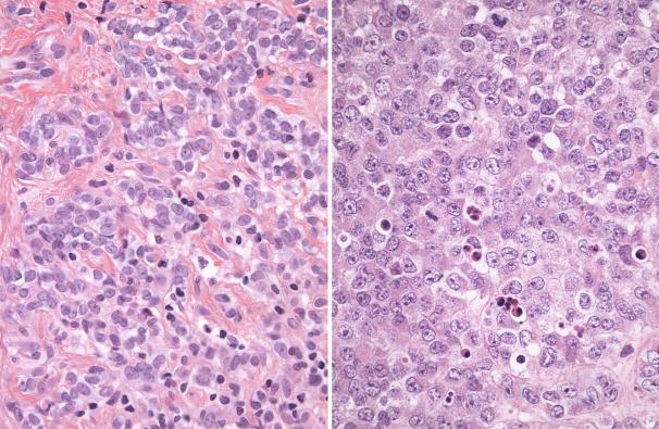 Figure 8.4, Ewing Sarcoma.