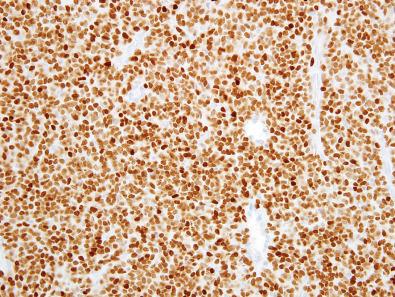 Figure 8.7, NKX2-2 in Ewing Sarcoma.