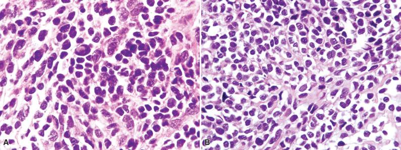 Figure 8.8, Small Cell Osteosarcoma.