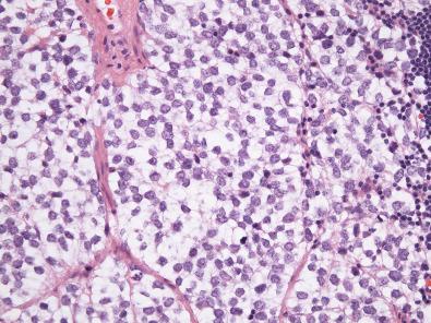 Figure 8.10, Alveolar Rhabdomyosarcoma.