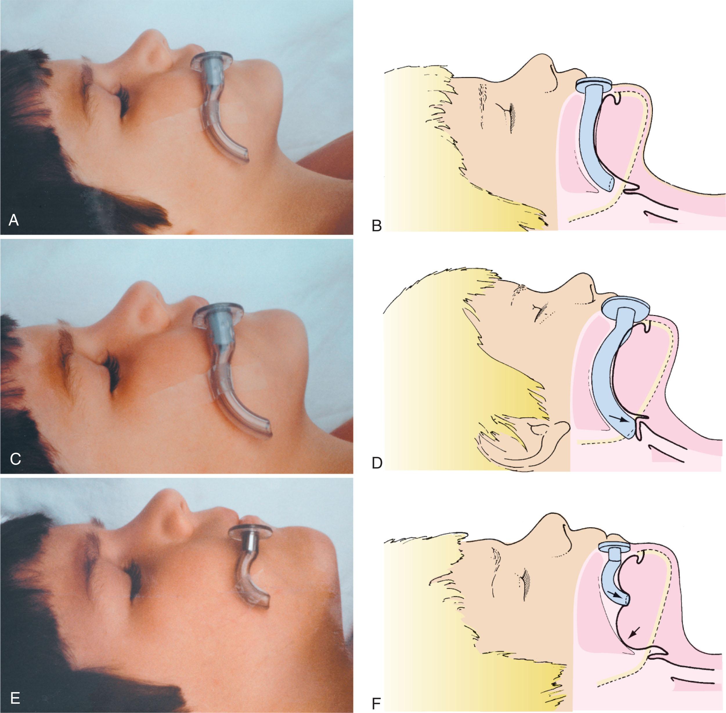 Fig 17.4, The oral airway. The oral airway should curve around the tongue to the angle of the mandible (A, B). A poorly sized oral airway can encroach on the laryngeal inlet (C, D) or obstruction (E, F).