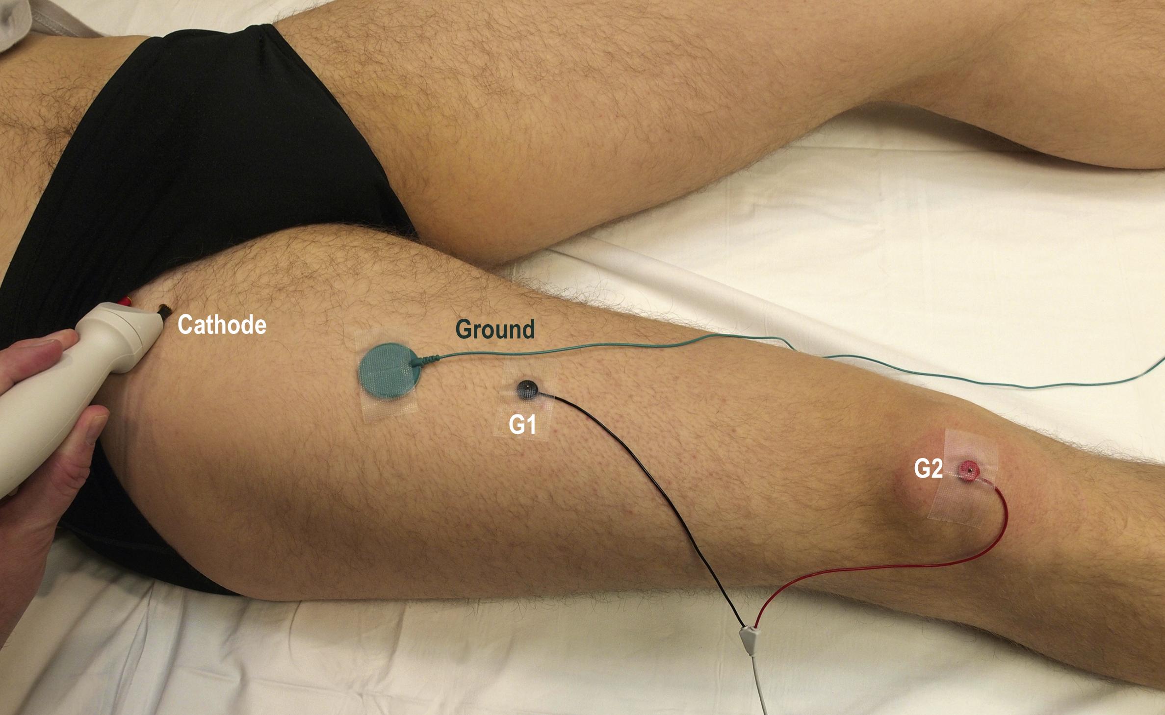 Fig. 11.4, Femoral motor study.