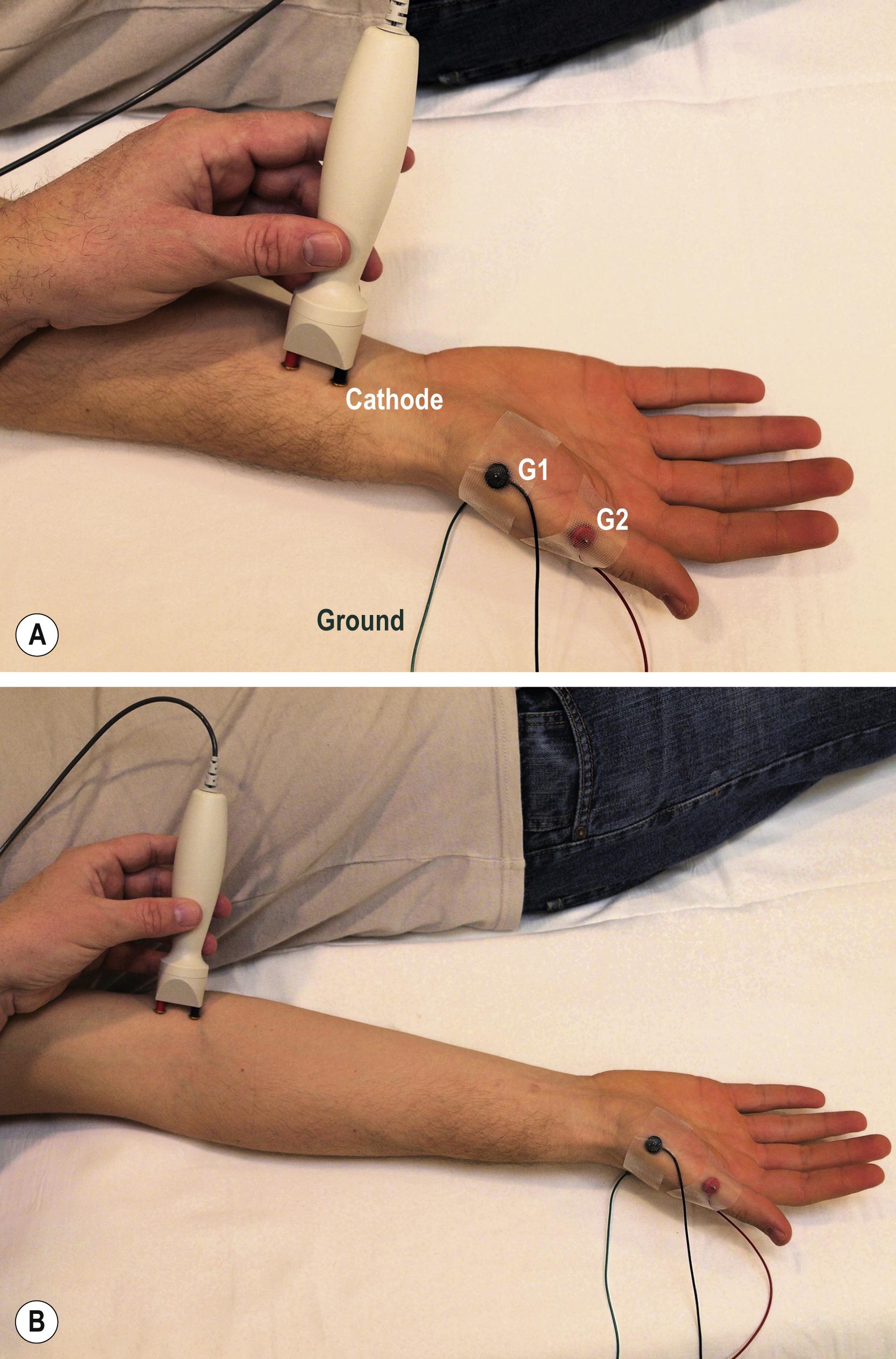 Fig. 10.1, Median motor study.