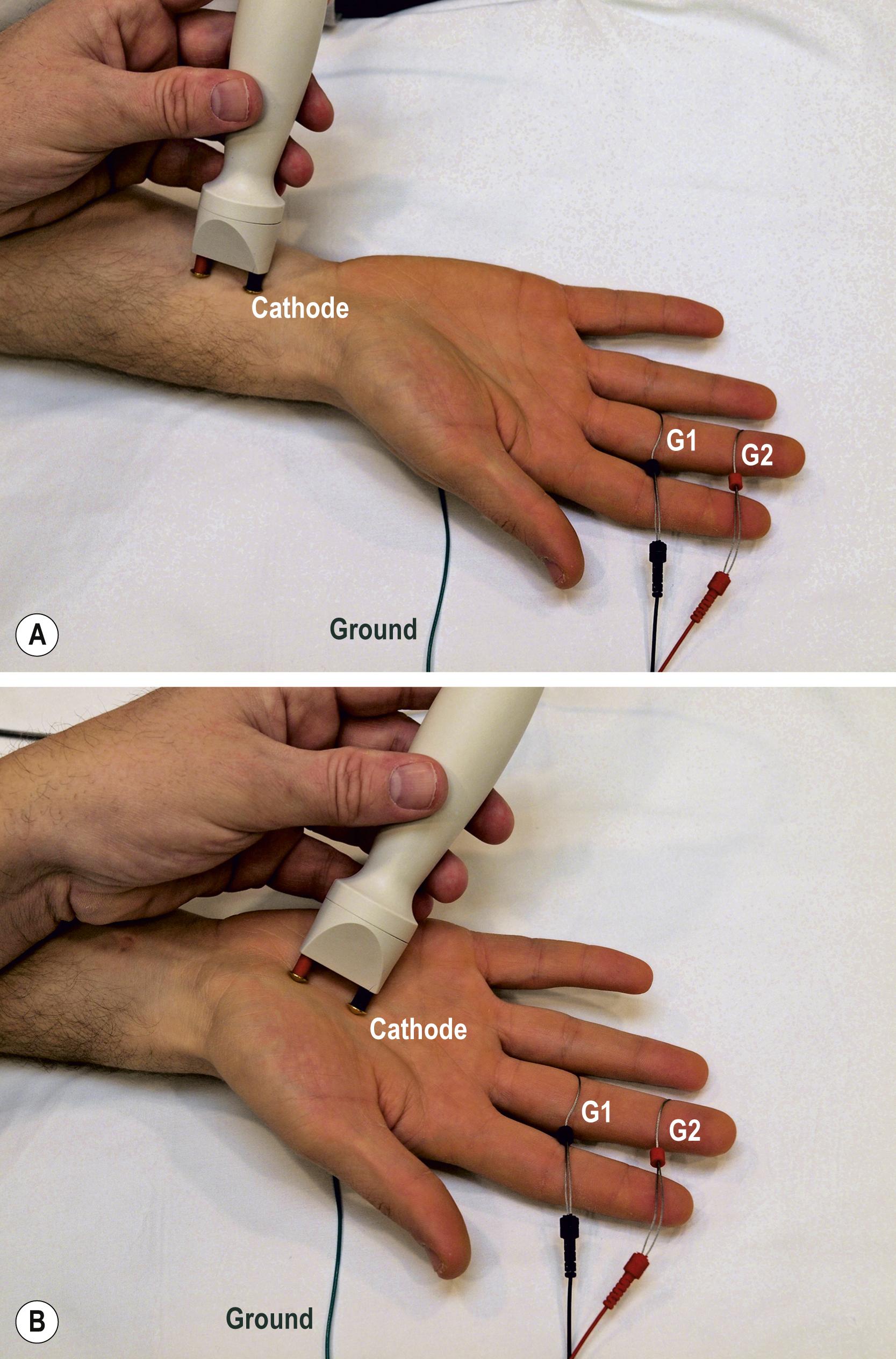 Fig. 10.4, Median sensory palmar study.