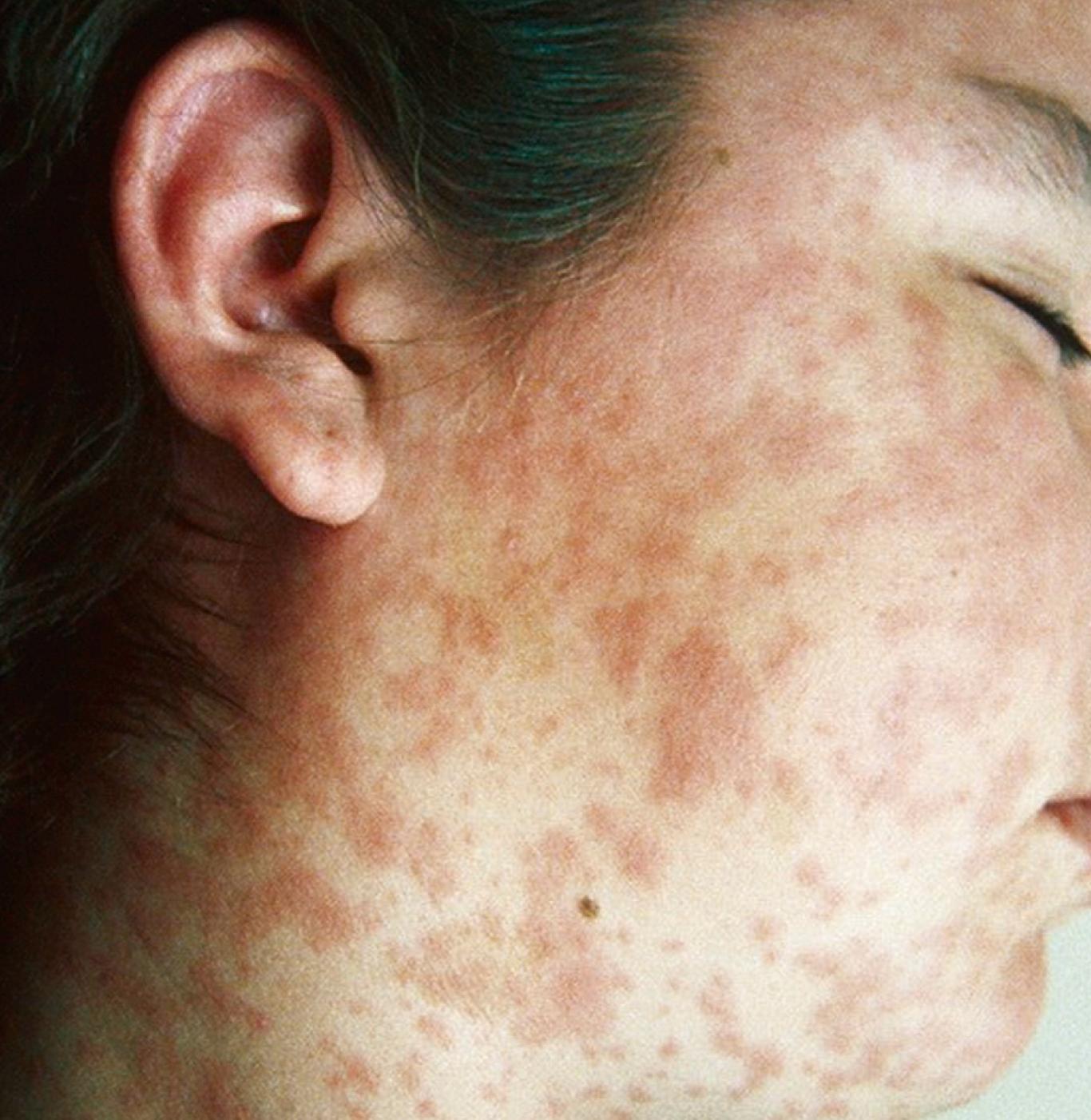 FIGURE 227.4, Typical rash on day 2 or 3 of measles.