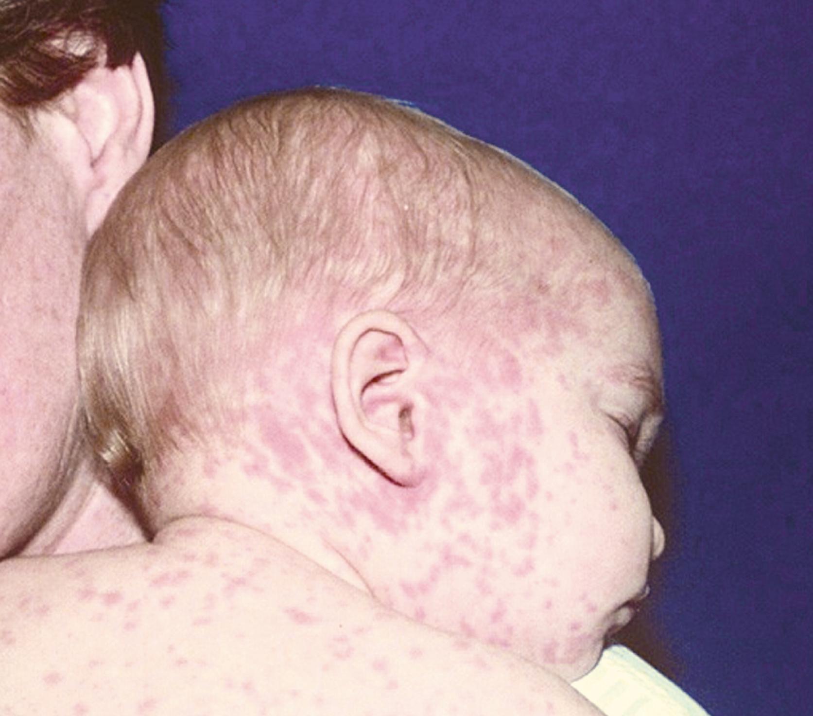 FIGURE 227.5, Measles rash on day 5, showing the typical confluence and density of lesions on the head and scattered lesions on the trunk.