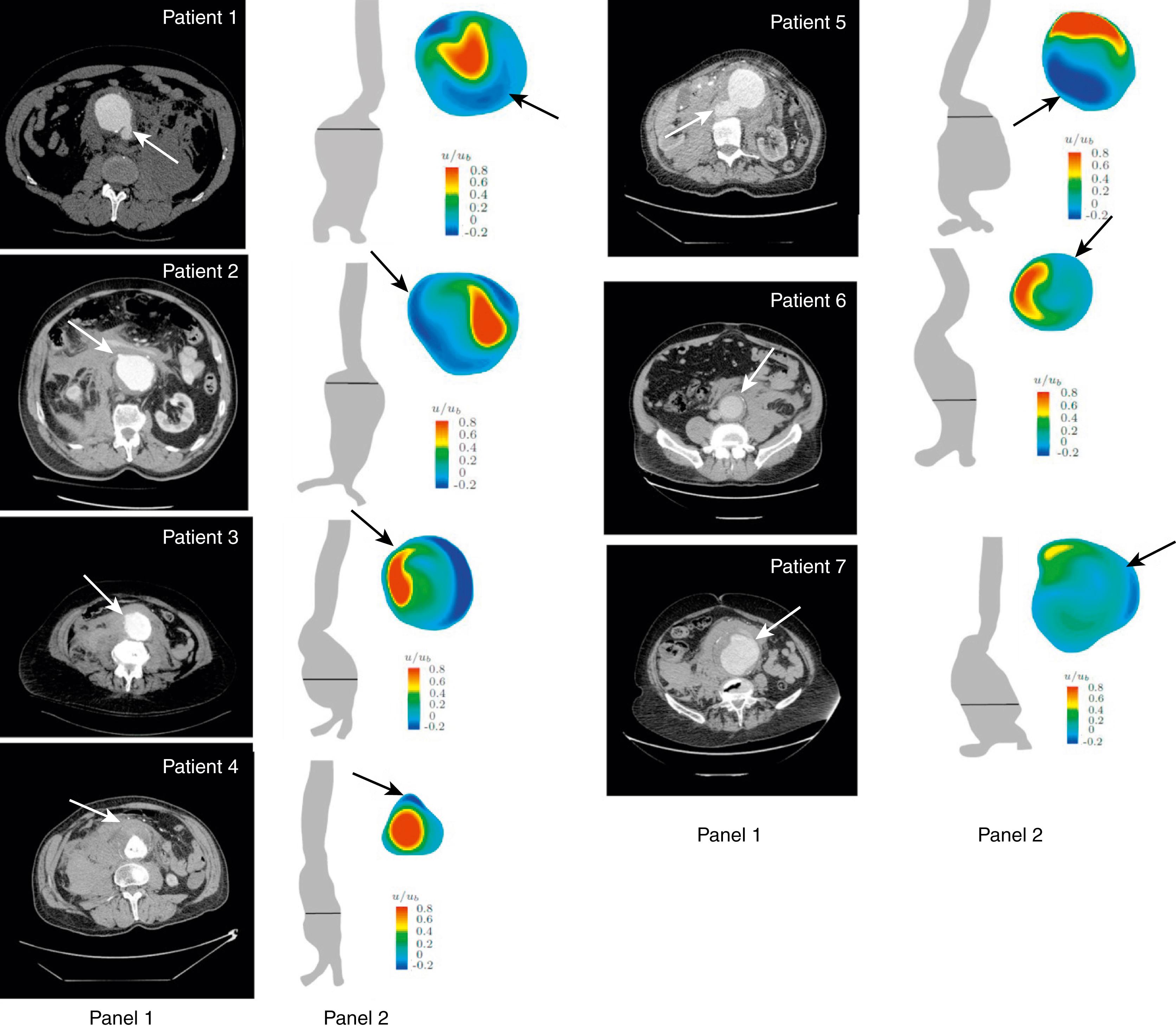 Figure 76.2, Panel 1: Axial computed tomography angiography (CTA) images of seven ruptured abdominal aortic aneurysms (RAAAs), indicating the location of rupture (white arrows). Panel 2: Anterior–posterior AAA flow channel silhouettes, indicating level of rupture (black line), and cross-sectional images of normalized velocity profiles, indicating the location of rupture (black arrows).