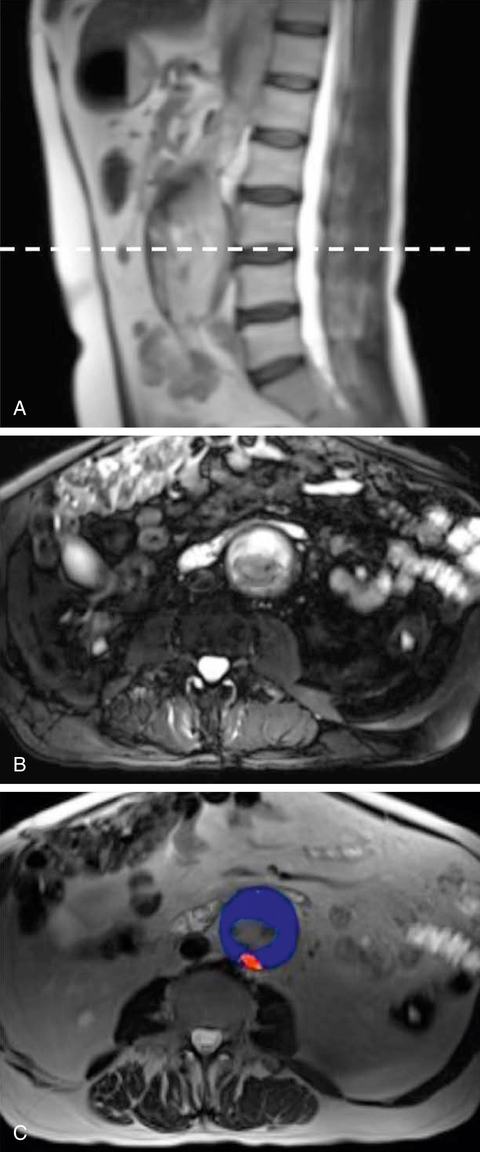 Figure 76.3, MRI of Abdominal Aortic Aneurysm.