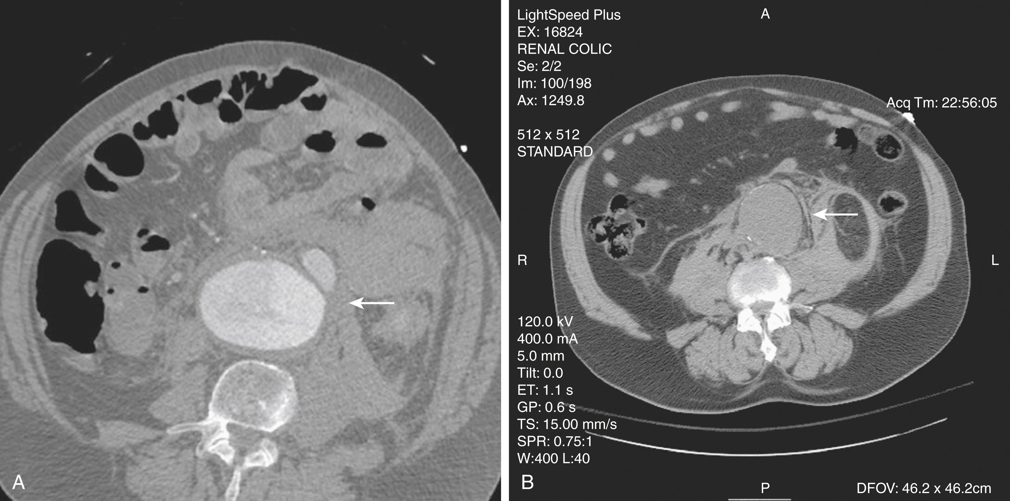 Figure 76.4, ( A ) Frank rupture of an infrarenal abdominal aortic aneurysm with contained extravasation (arrow) . ( B ) Computed tomography scan of a ruptured abdominal aortic aneurysm. Note the pattern of stranding of blood into the tissues (arrow). No contrast material was used, and the scan was performed for the diagnosis of renal colic.