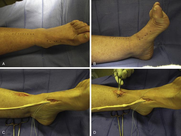 Fig. 8.2, A chronic rupture was present in this patient who presented 6 months following the initial rupture episode. (A,B) The skin incisions are marked out. Note that the proximal incision is anterolateral, lateral to the passage of the anterior tibial tendon. (C) The allograft is now attached to the medial cuneiform with a double drill hole technique supplemented by a suture anchor. (D) The distal stump of the anterior tibial tendon is now indentified and pulled with a hemostat clamp until it is quite free in the incision. (E) The allograft is passed deep to the retinaculum and the distal anterior tibial tendon cut sharply proximal to the zone of tendon injury. The allograft is now slightly thinned to facilitate passage through the anterior tibial tendon using a weave type attachment. (F) It is important to maintain the tension at each passage of the tendon. (G) The tendon graft is finally sutured into the anterior tibial tendon using a 2-0 slowly resorbable suture.