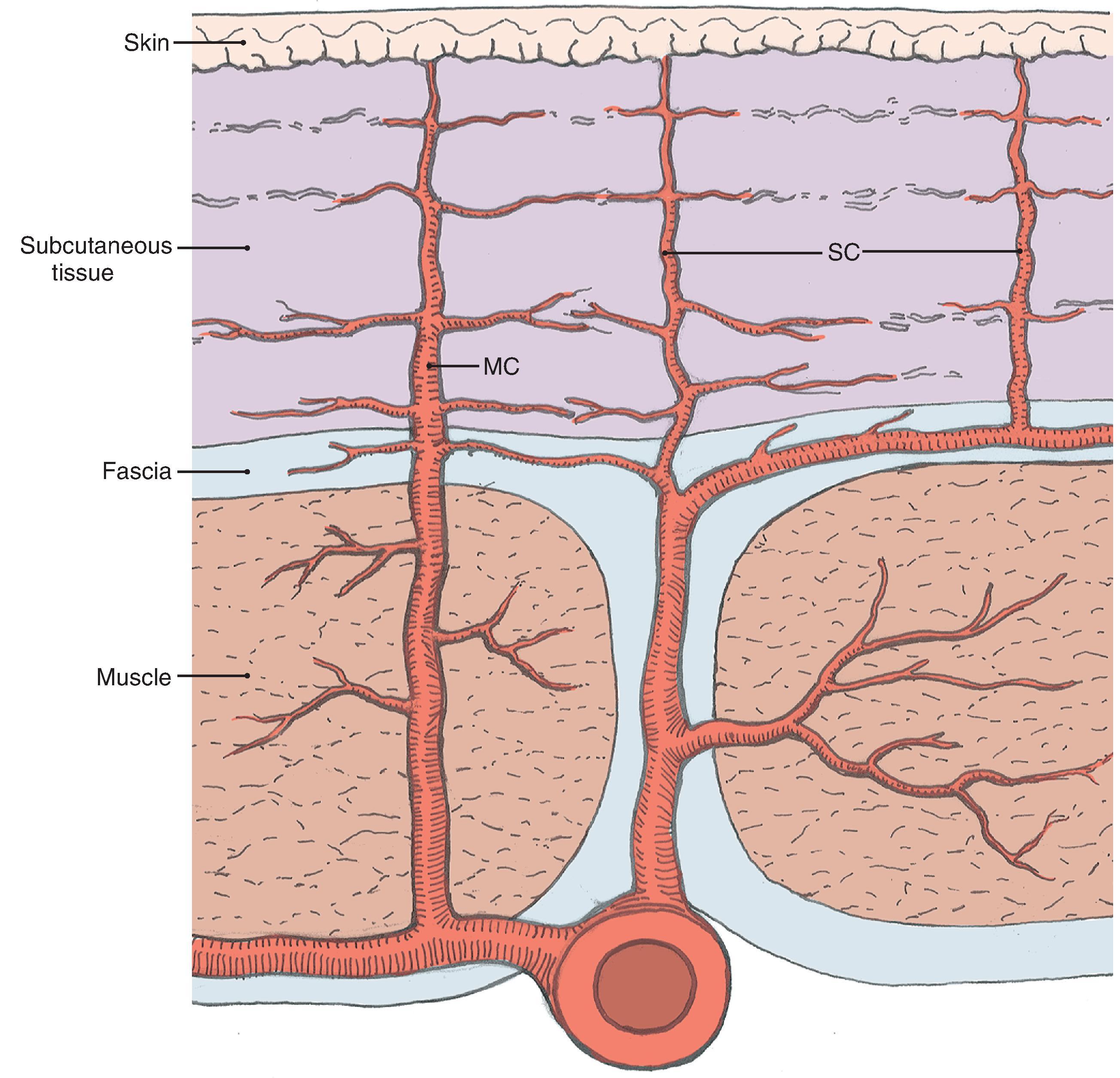 FIG. 2.2, Depiction of varying pathways to skin that defines musculocutaneous (MC) and septocutaneous (SC) arteries.