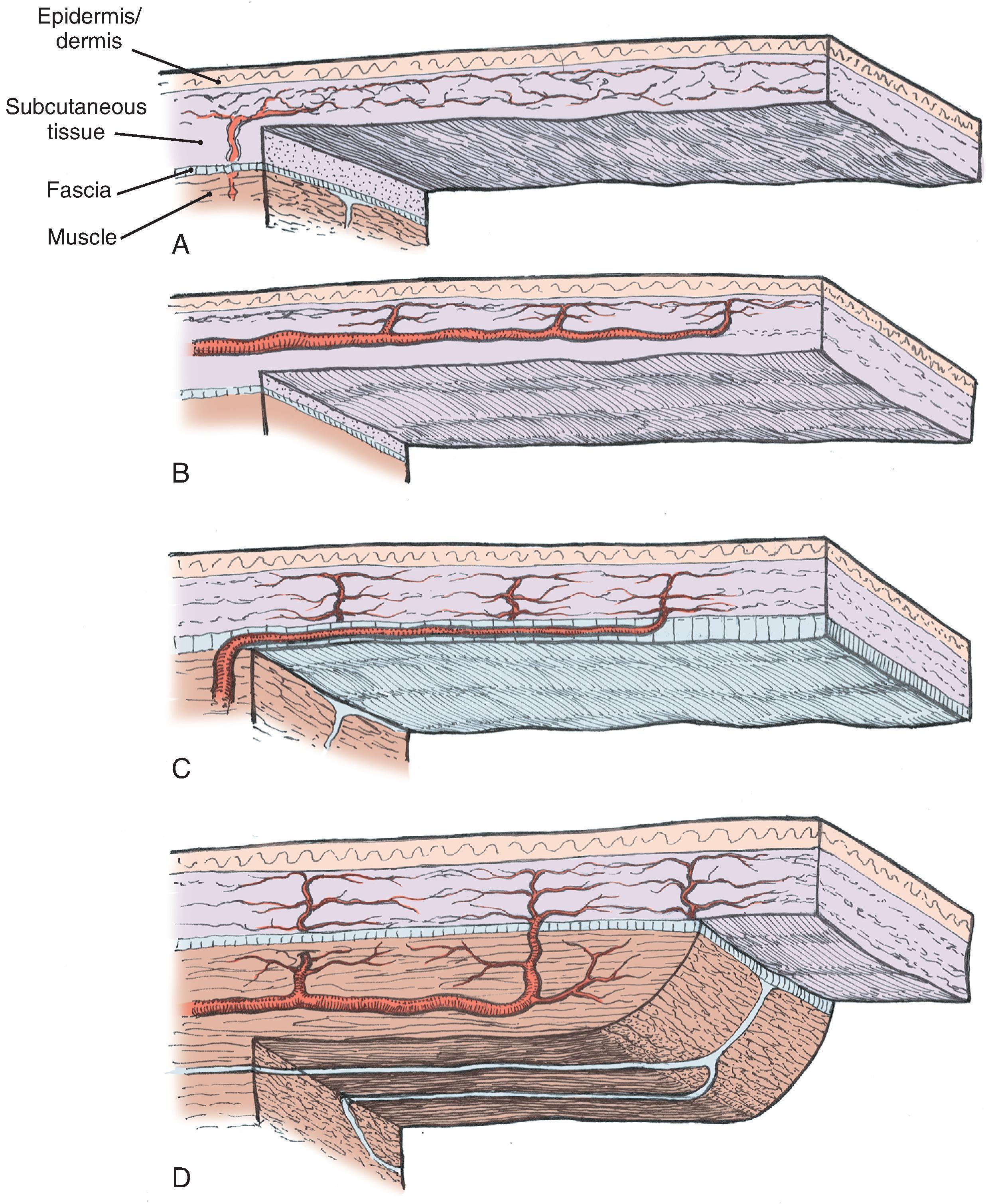 FIG. 2.3, Classification of skin flaps based on vascular supply. A , Random. B , Arterial cutaneous. C , Fasciocutaneous. D , Musculocutaneous.