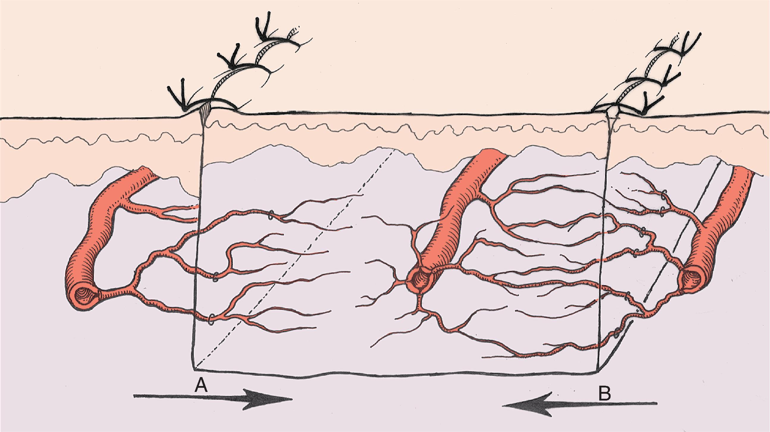 FIG. 2.7, Cross section of flap demonstrating direct ingrowth ( A ) versus inosculation ( B ).