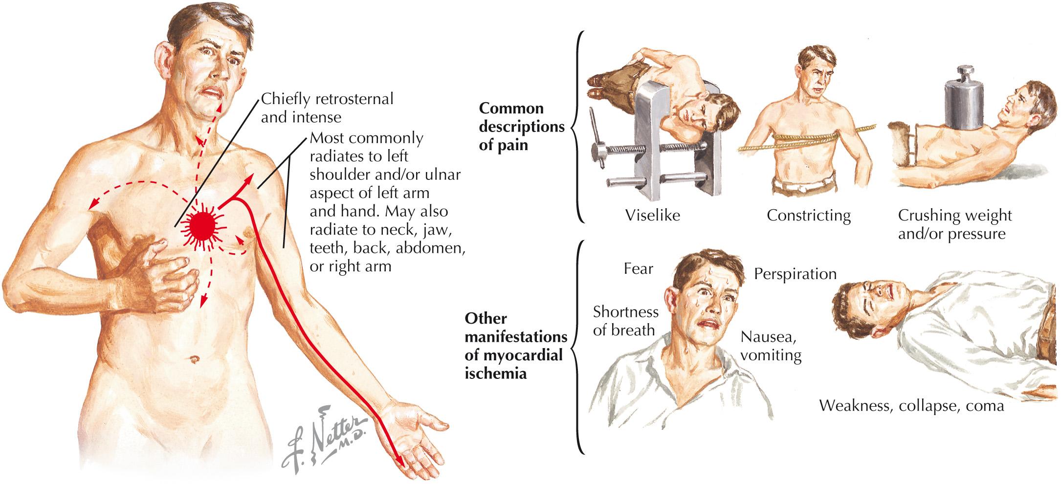 FIG 21.2, Characteristics of Chest Pain in Myocardial Ischemia.