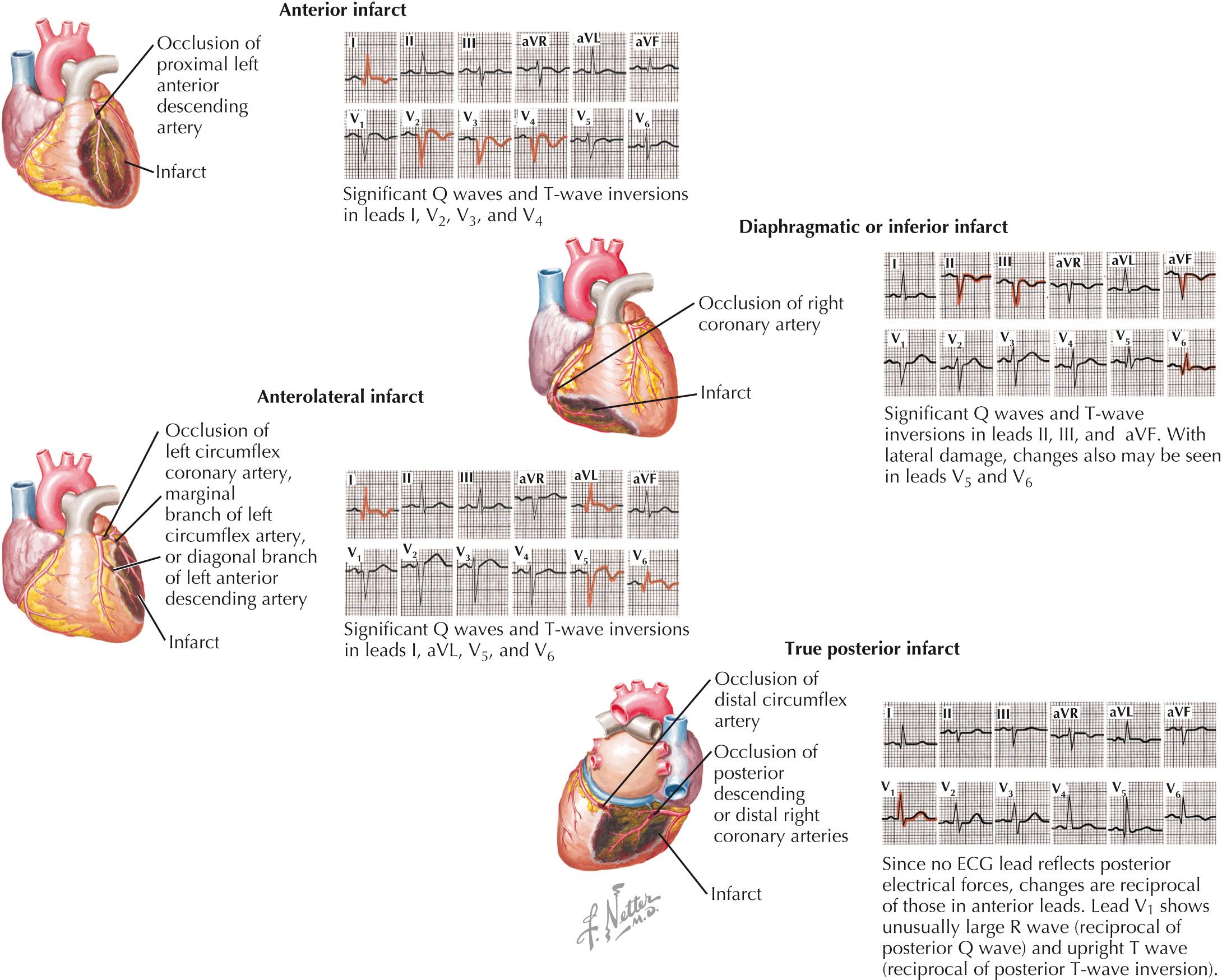 FIG 21.3, ECG Localization of ST-Elevation Myocardial Infarction.