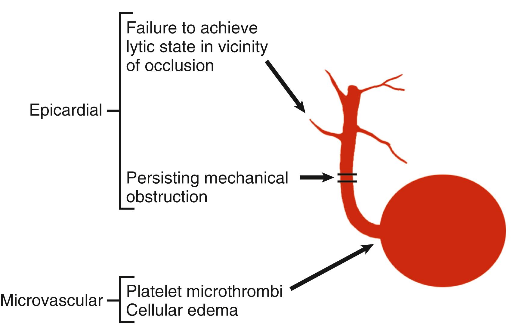 EFIGURE 38.2, Points of possible failure of reperfusion therapy. Complete reperfusion requires successful restoration of normal flow in both the epicardial coronary artery and the distal coronary microvasculature, termed myocardial tissue-level reperfusion . Failure of epicardial reperfusion can result from failure to induce a lytic state or from persistent mechanical obstruction at the site of occlusion. Failure of microvascular reperfusion is caused by a combination of platelet microthrombi followed by endothelial swelling and myocardial edema (“no-reflow”). Reperfusion may fail because of persistent occlusion of the epicardial infarct-related artery (TIMI grades 0 and 1), patency of an epicardial artery in the presence of impaired (TIMI grade 2) flow, or microvascular occlusion in the presence of angiographically normal (TIMI grade 3) flow. Successful reperfusion requires a patent artery with an intact microvascular network.