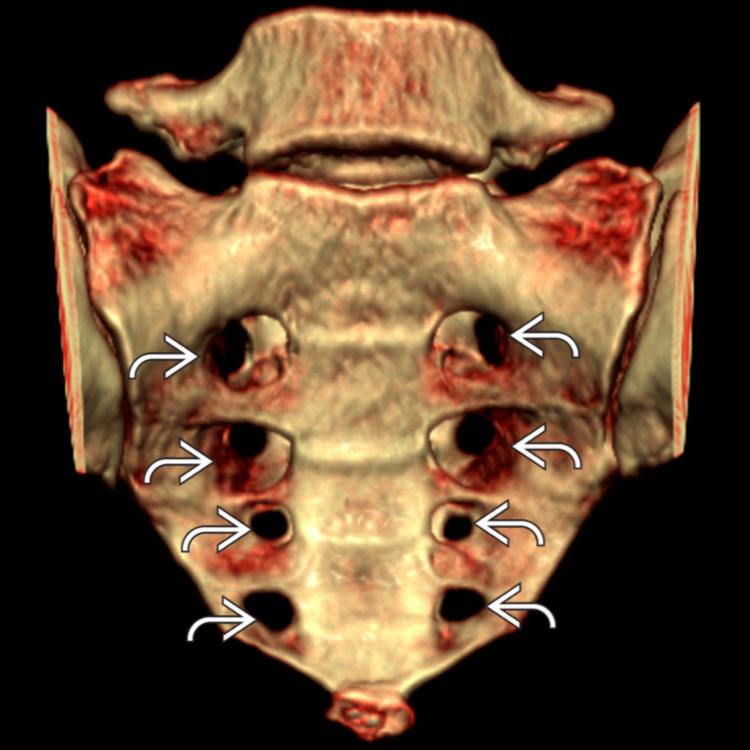 Preprocedure Imaging: 3D CT