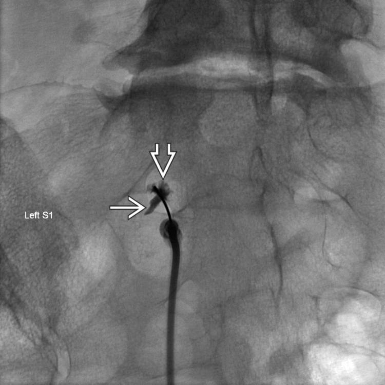 Foraminal Contrast Injection: AP View