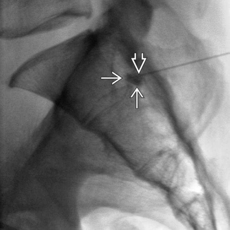 Needle Placement Confirmed: Lateral View